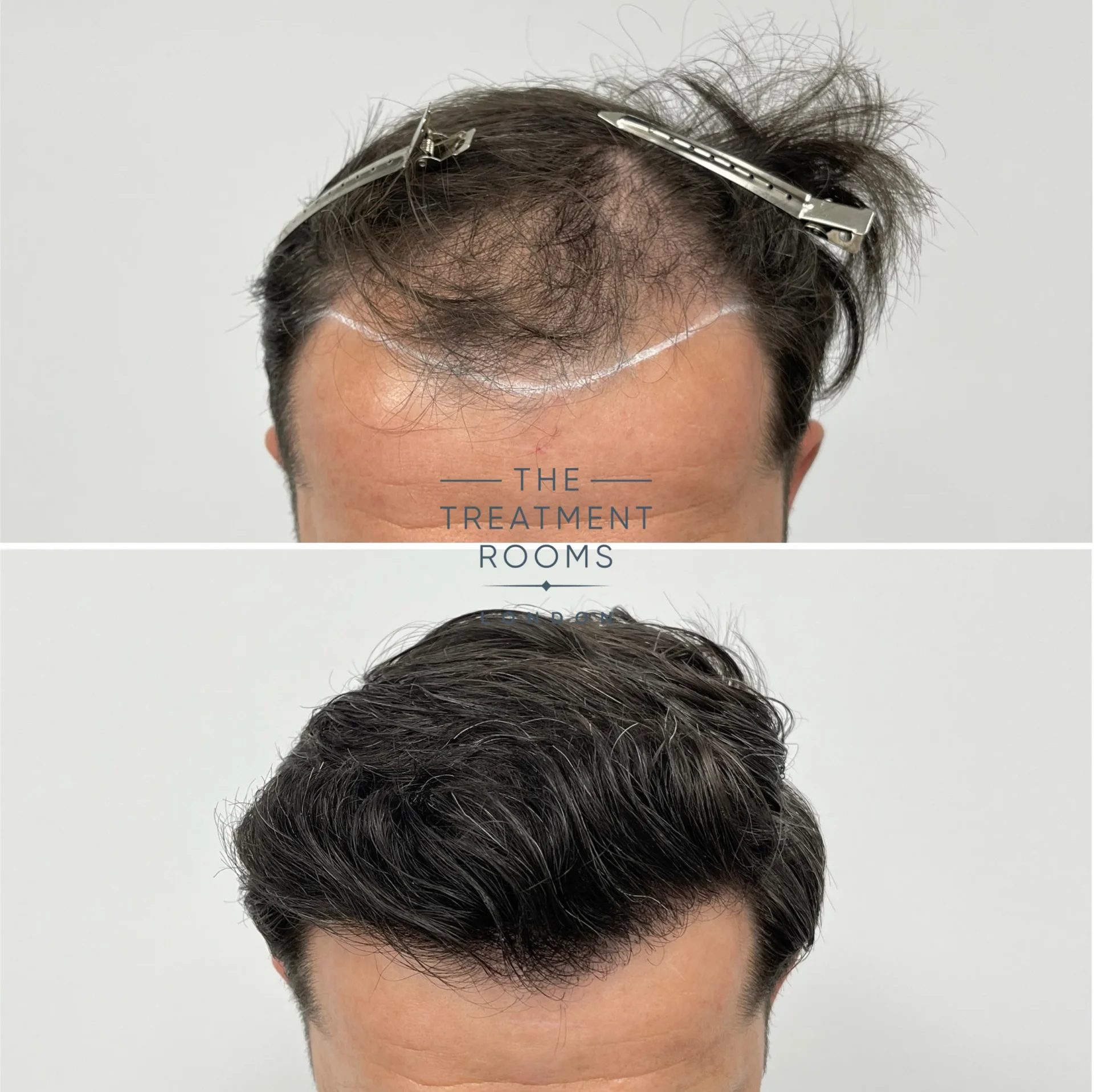 best fue hair transplant before and after 1868 grafts