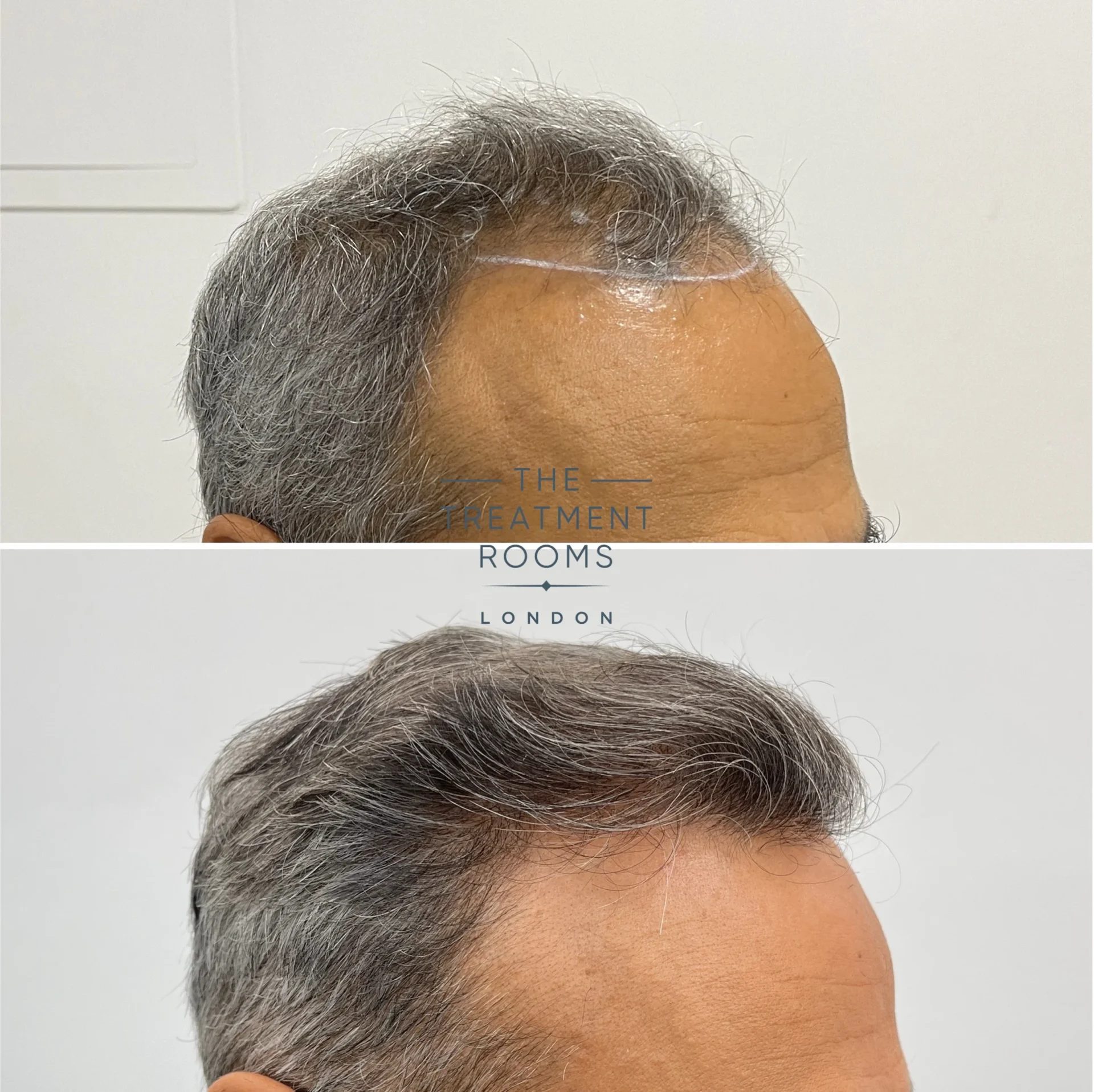 best fue hair transplant clinic london before and after 2343 grafts