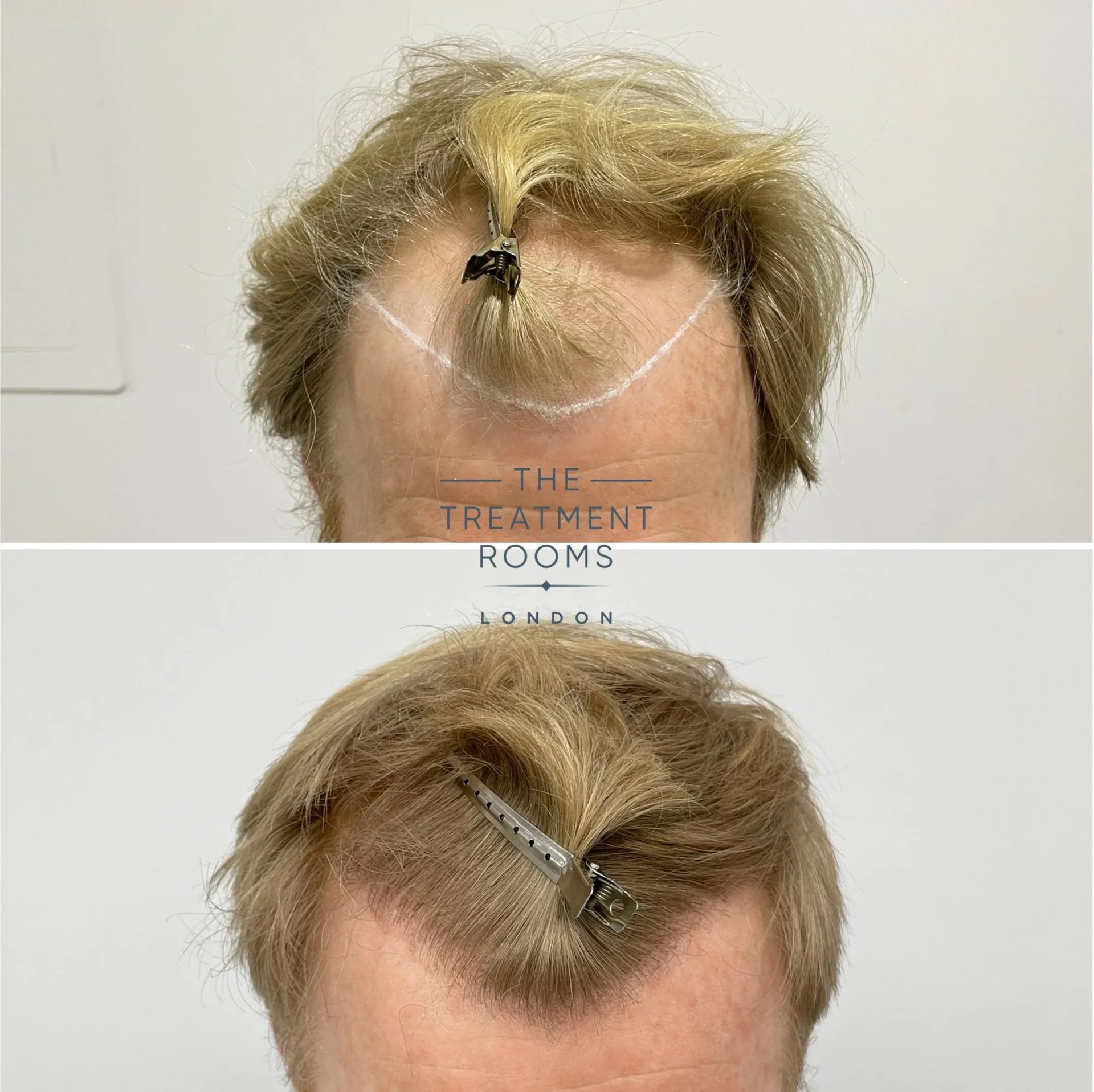 best fue hair transplant london 2087 grafts