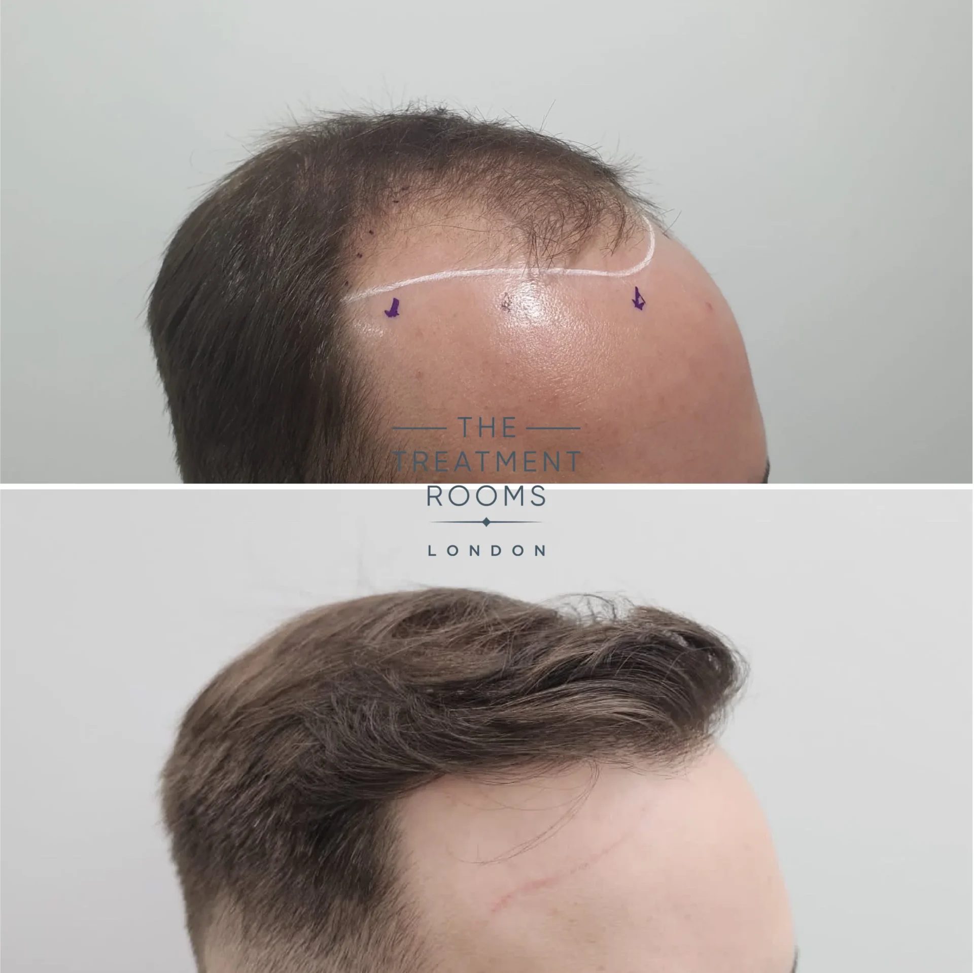 best fue transplant clinic london