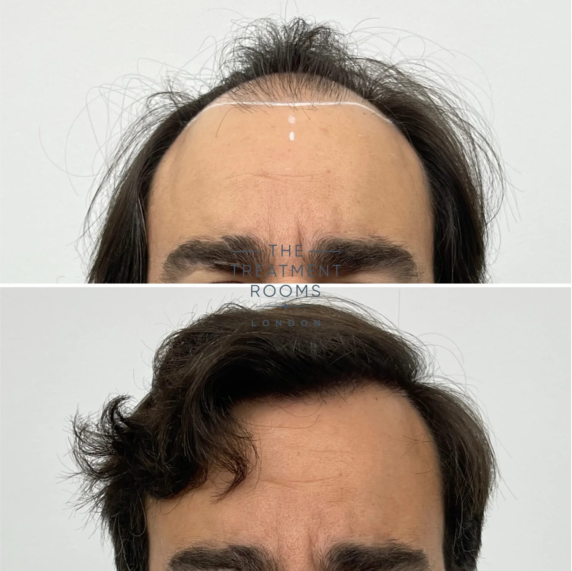 best hair transplant 2148 grafts before and after
