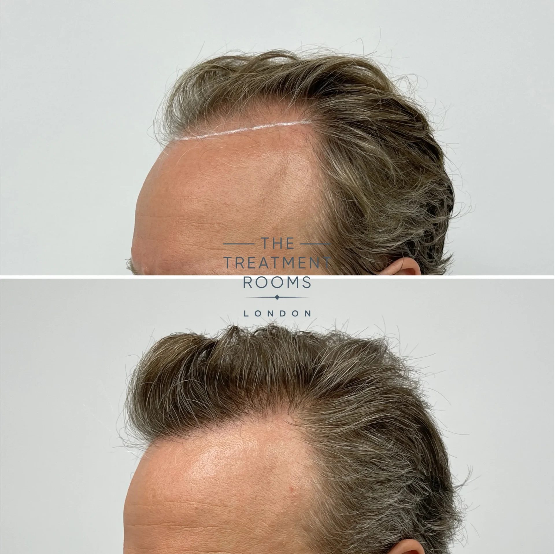 best hair transplant 2278 grafts before and after