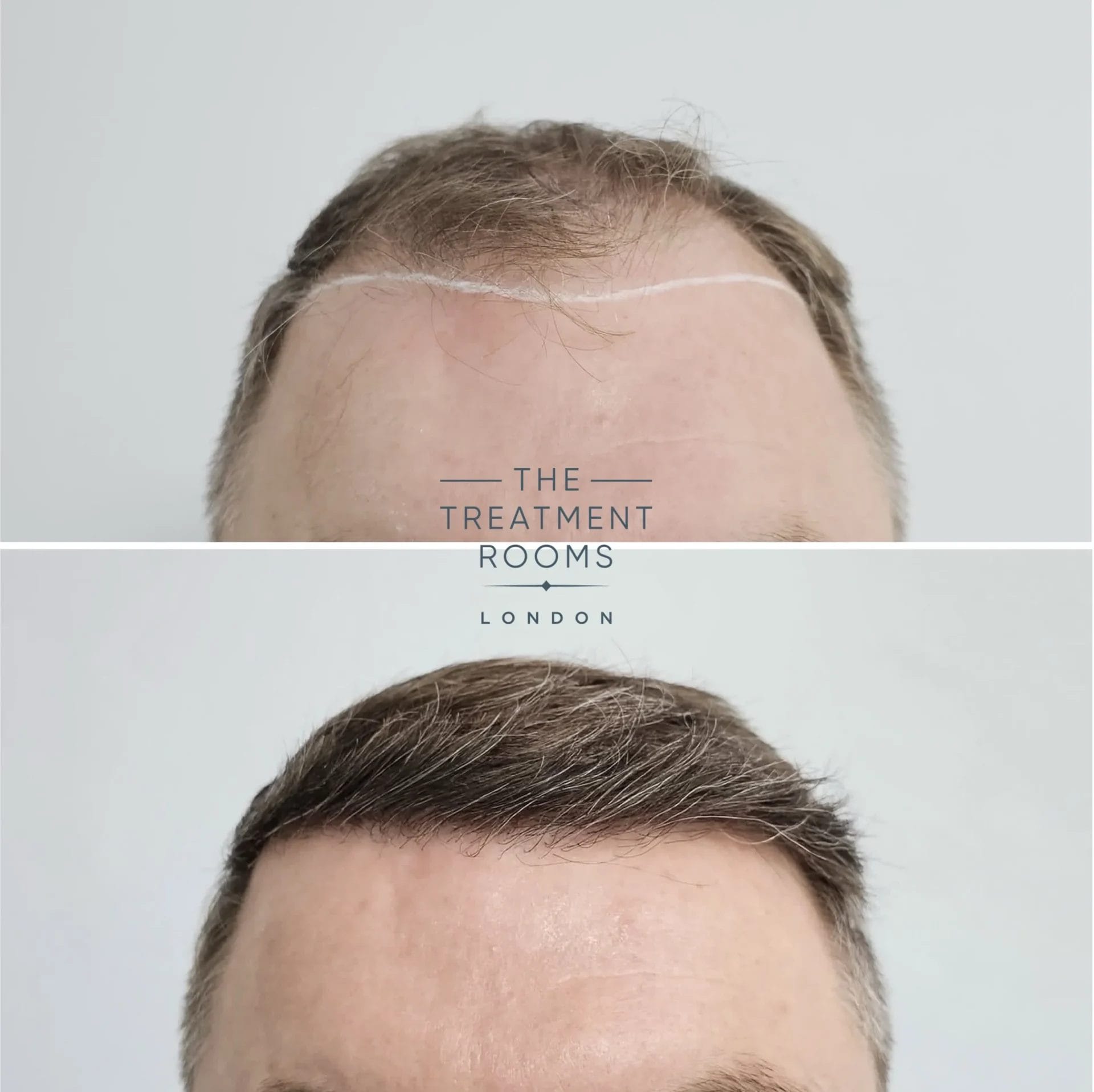 best hair transplant before and after 2109 grafts