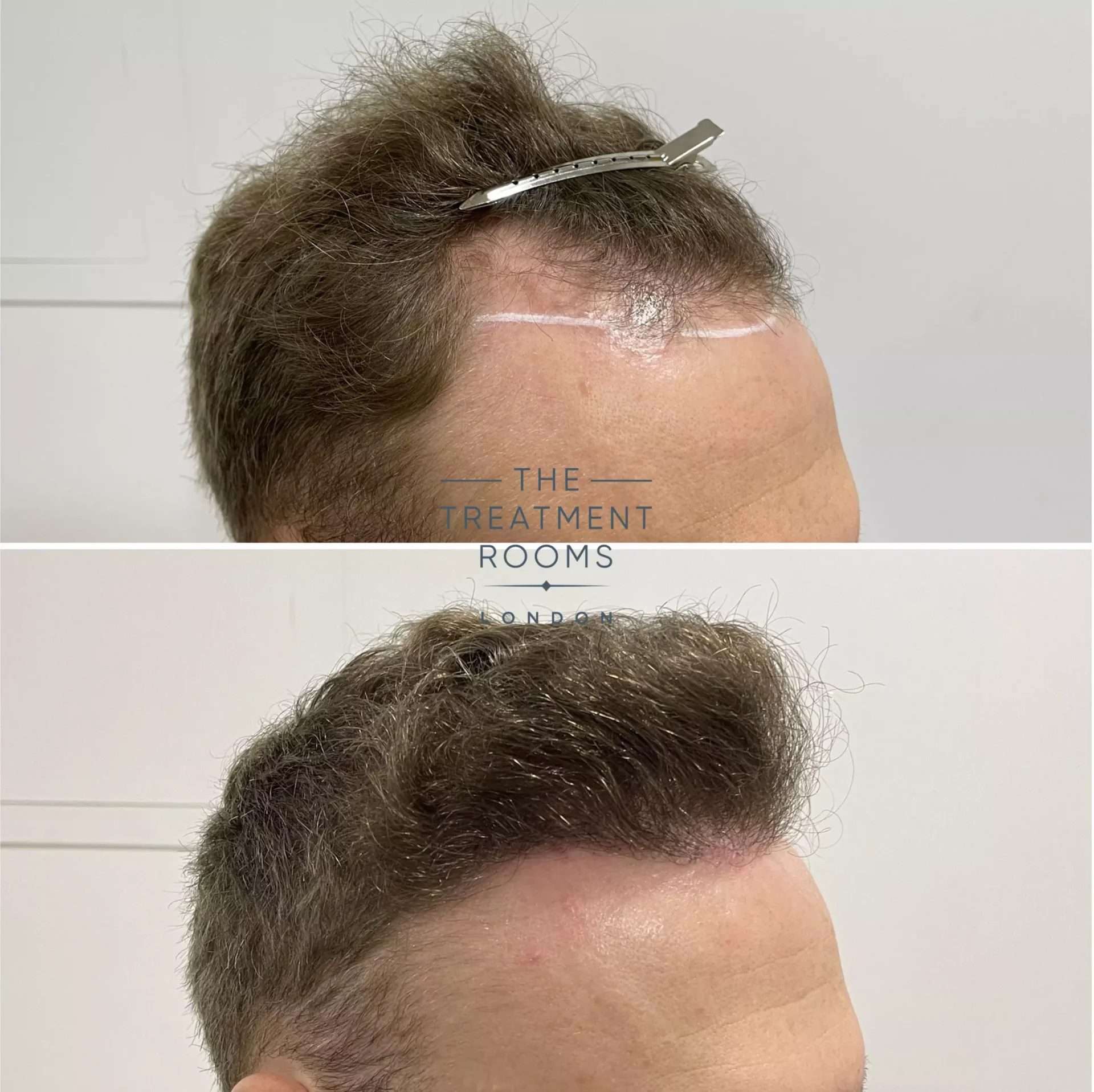 best hair transplant clinic UK 1346 grafts before and after best hair transplant clinic UK 1346 grafts before and after