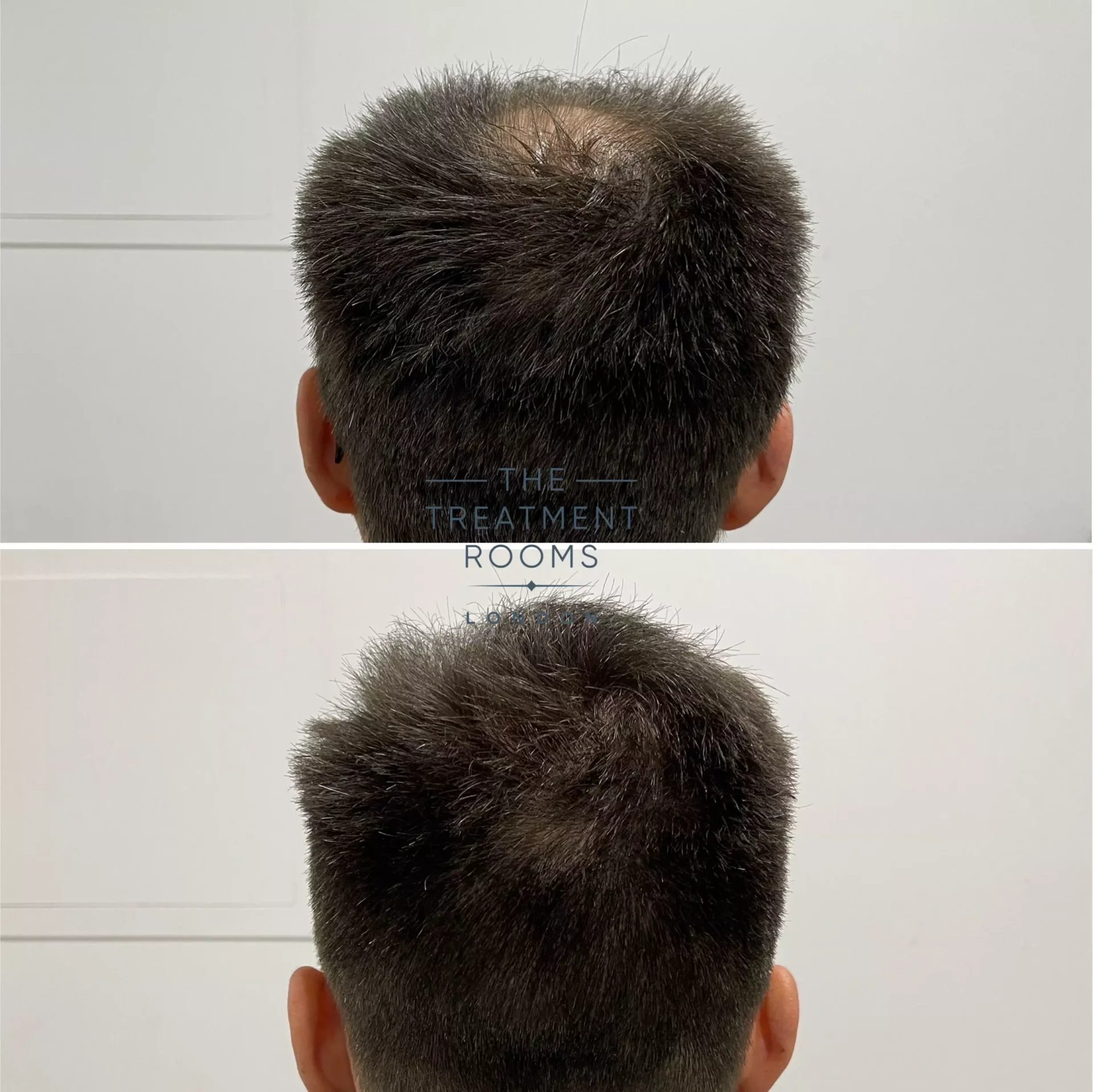 best hair transplant clinic for crown 1930 grafts before and after best hair transplant clinic for crown 1930 grafts before and after