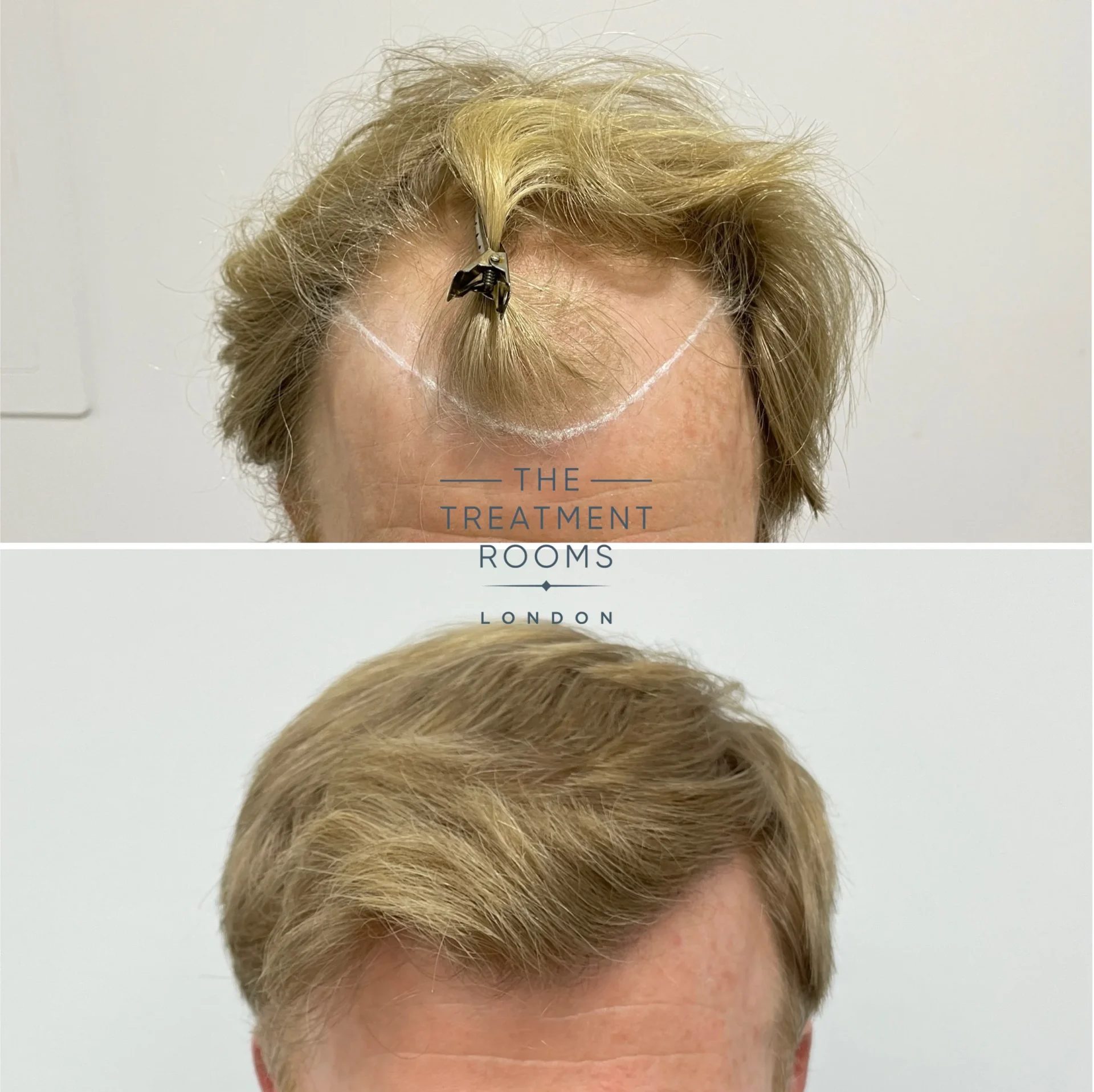 best hair transplant clinic london 2087 grafts