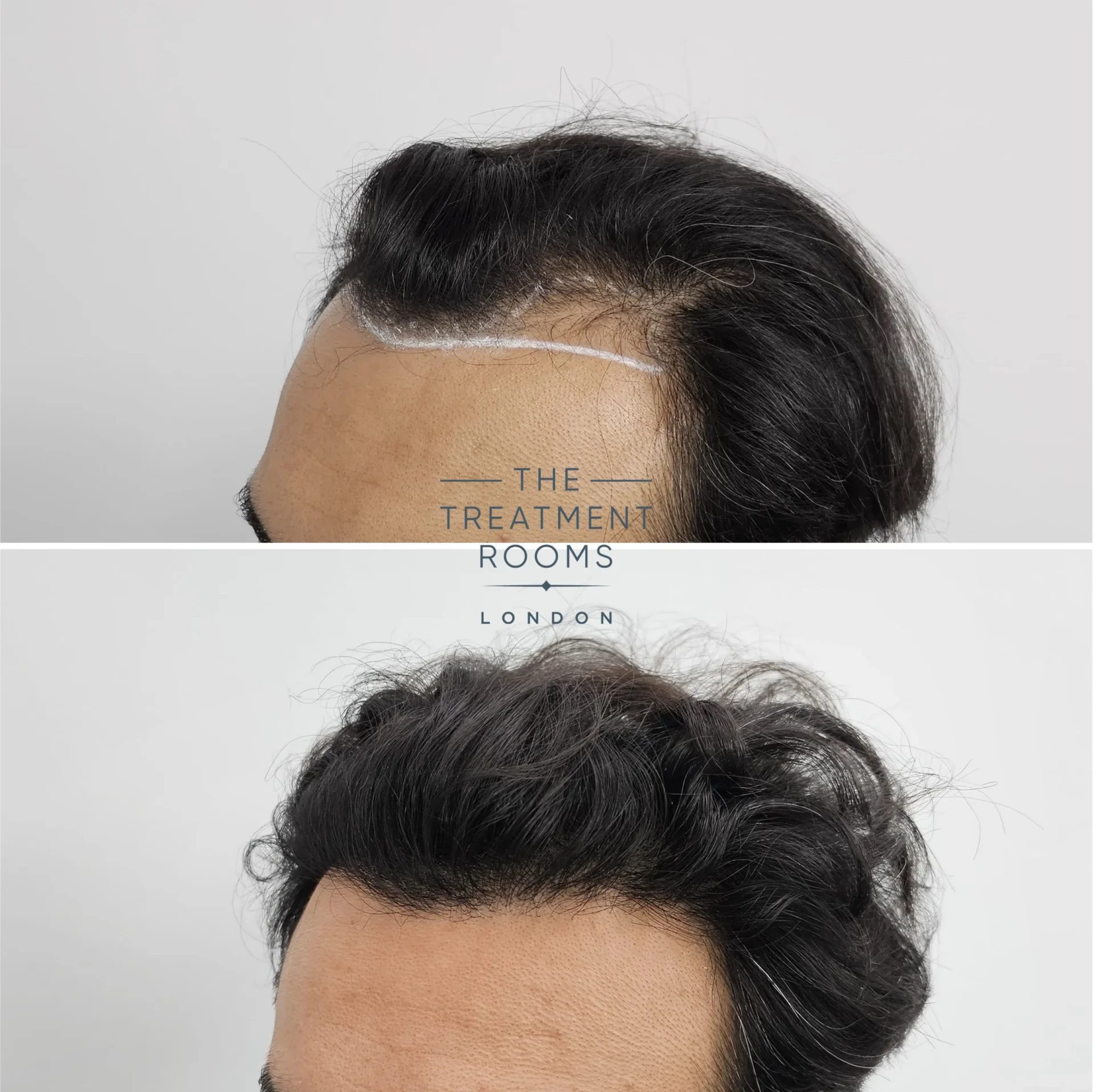 best hair transplant clinic london before and after 1204 grafts