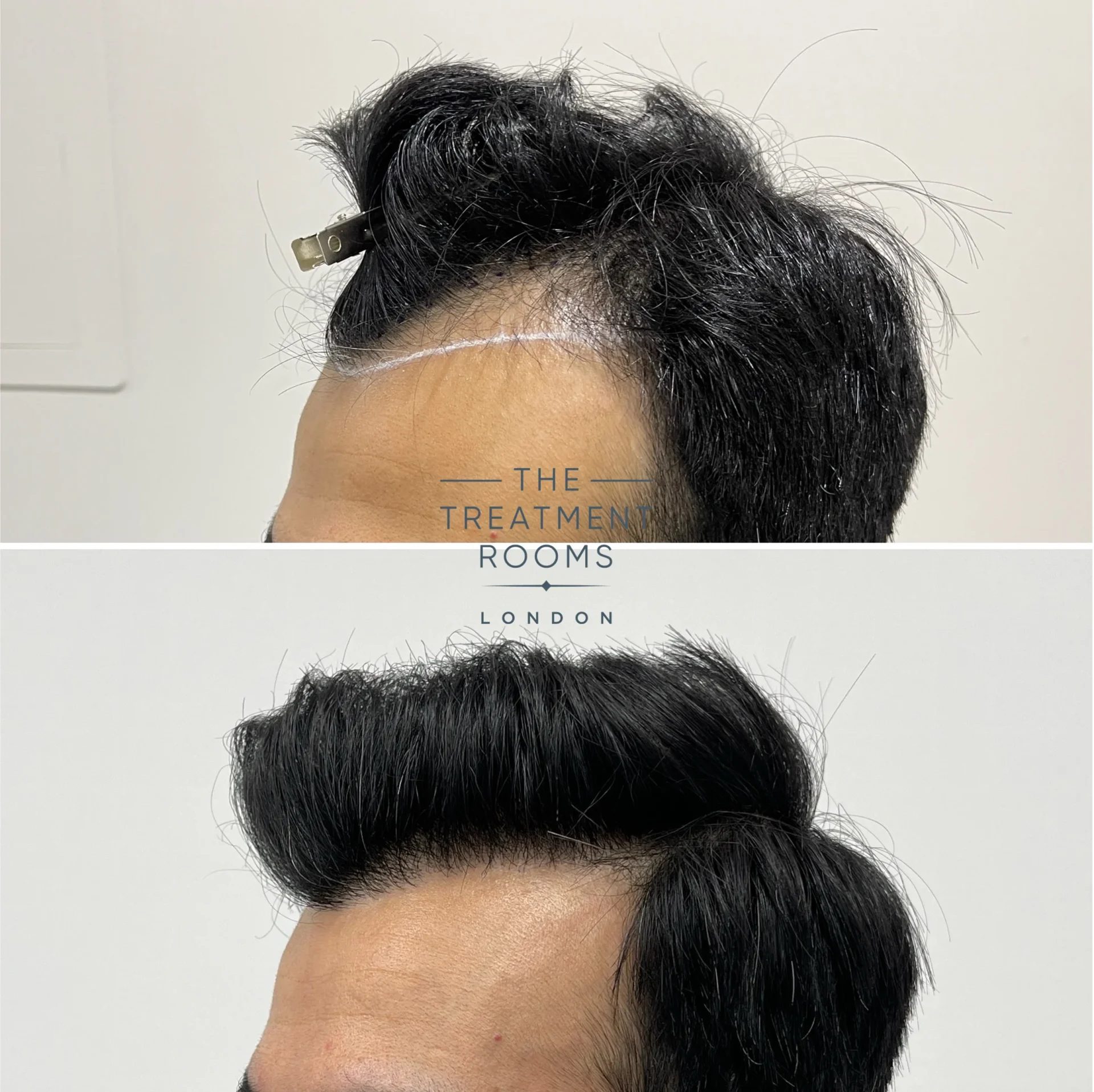 best hair transplant clinic london before and after 1523 grafts