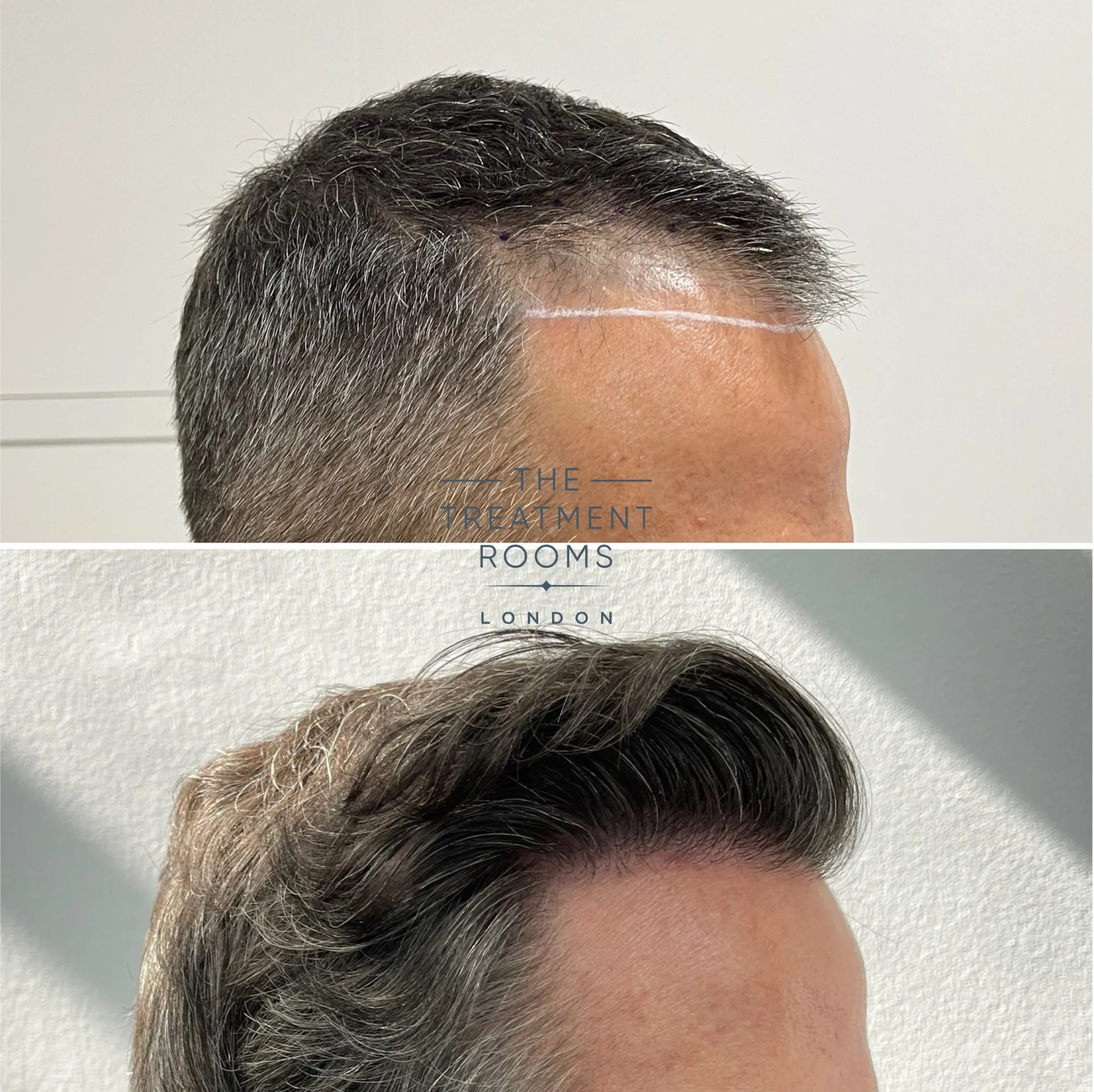 best hair transplant clinic london result