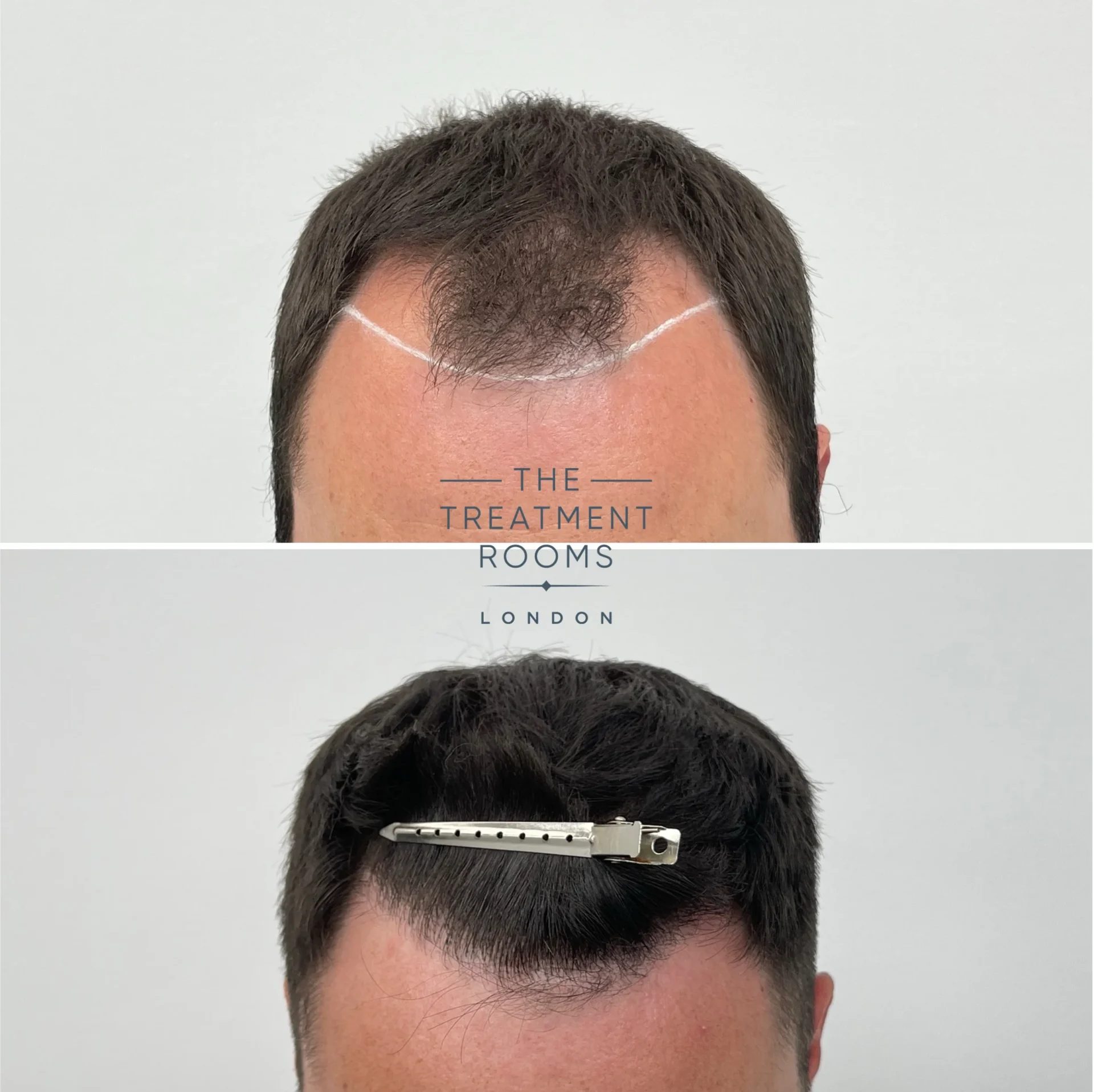best hair transplant london 1924 grafts before and after