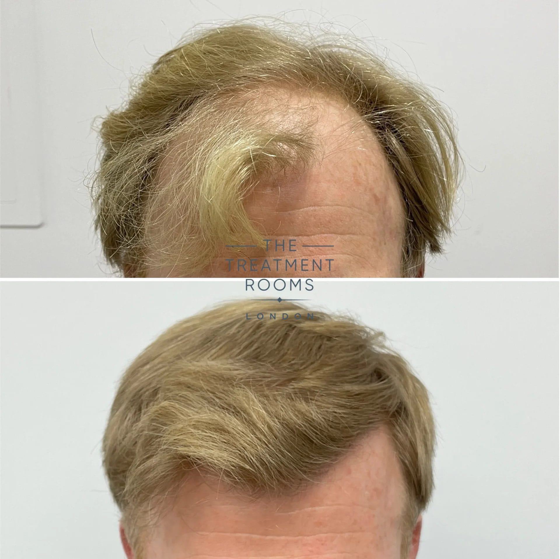 best hair transplant london 2087 grafts