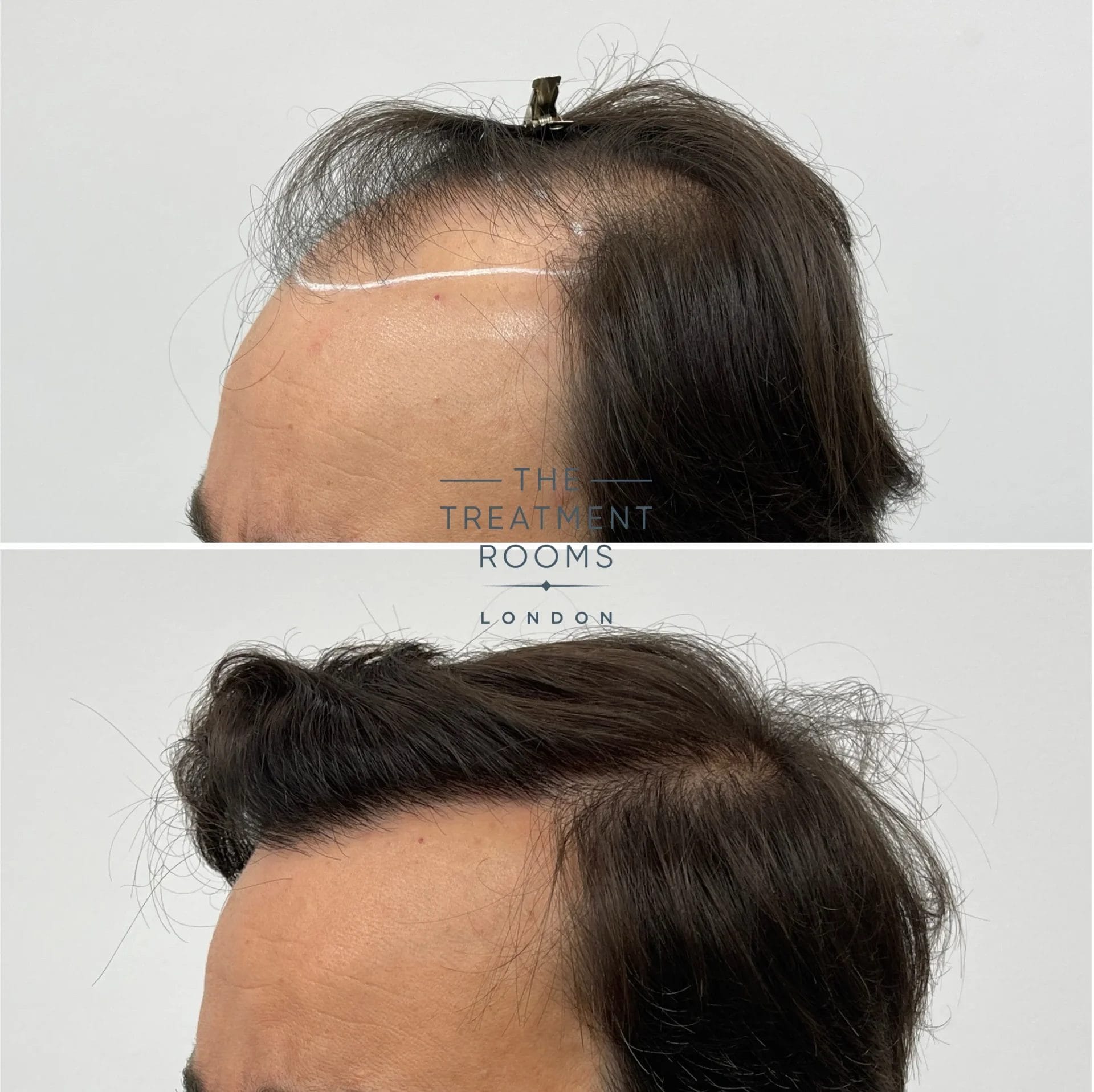 best hair transplant london 2148 grafts before and after