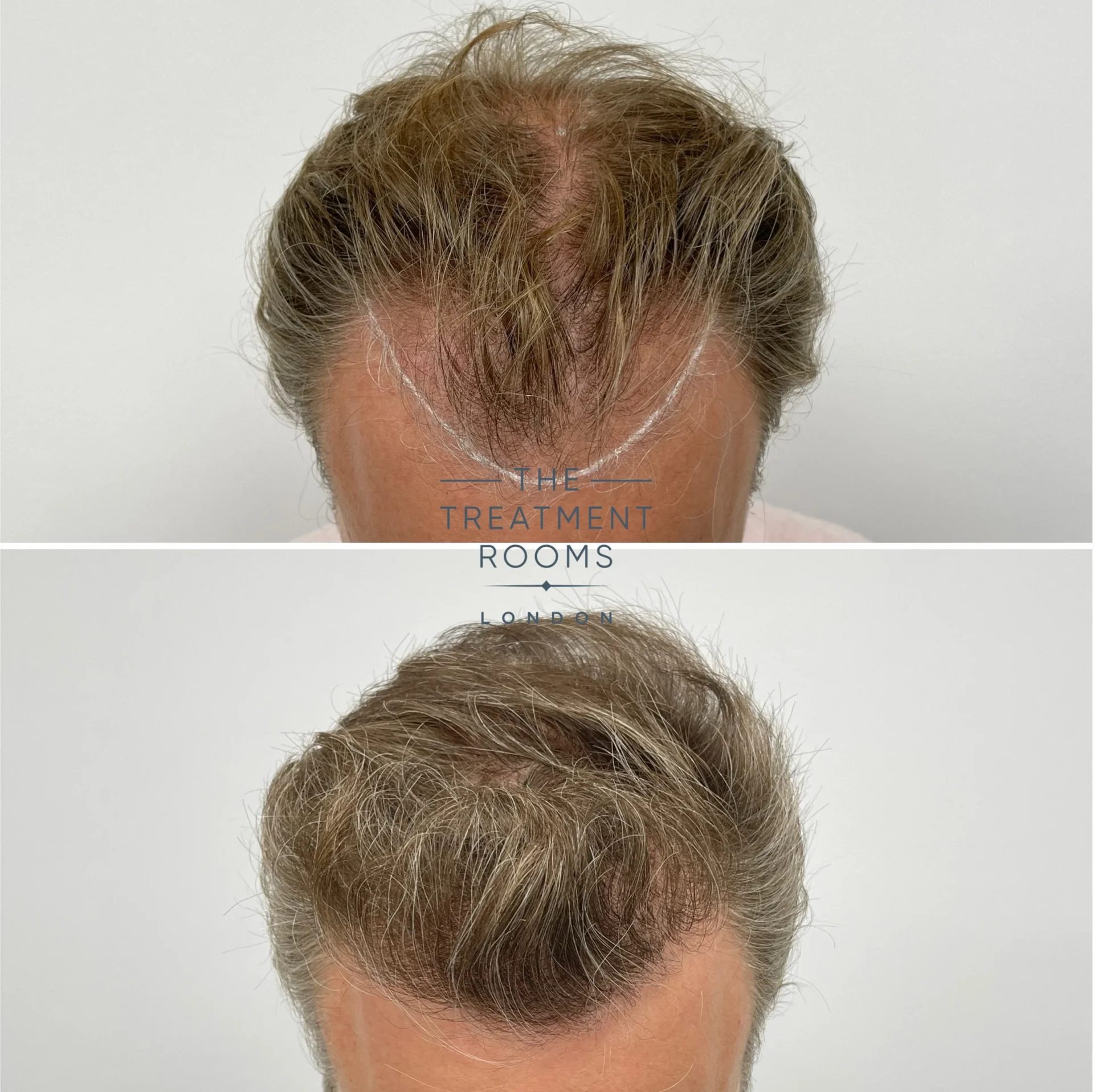 best hair transplant london 2278 grafts before and after