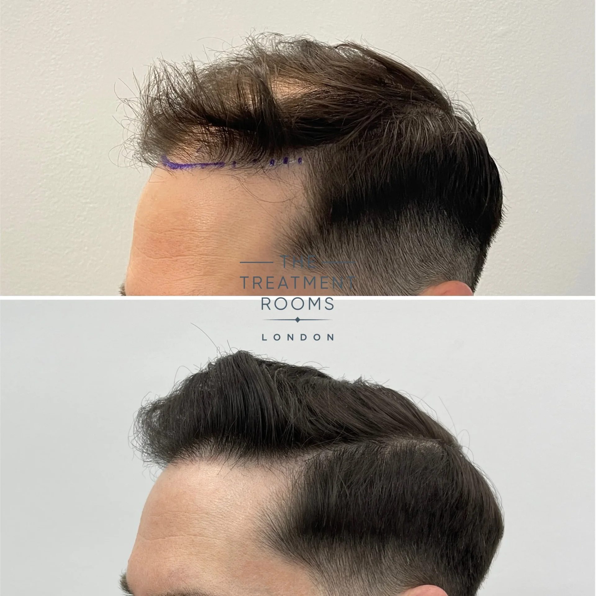 best hair transplant london before and after 1625 grafts