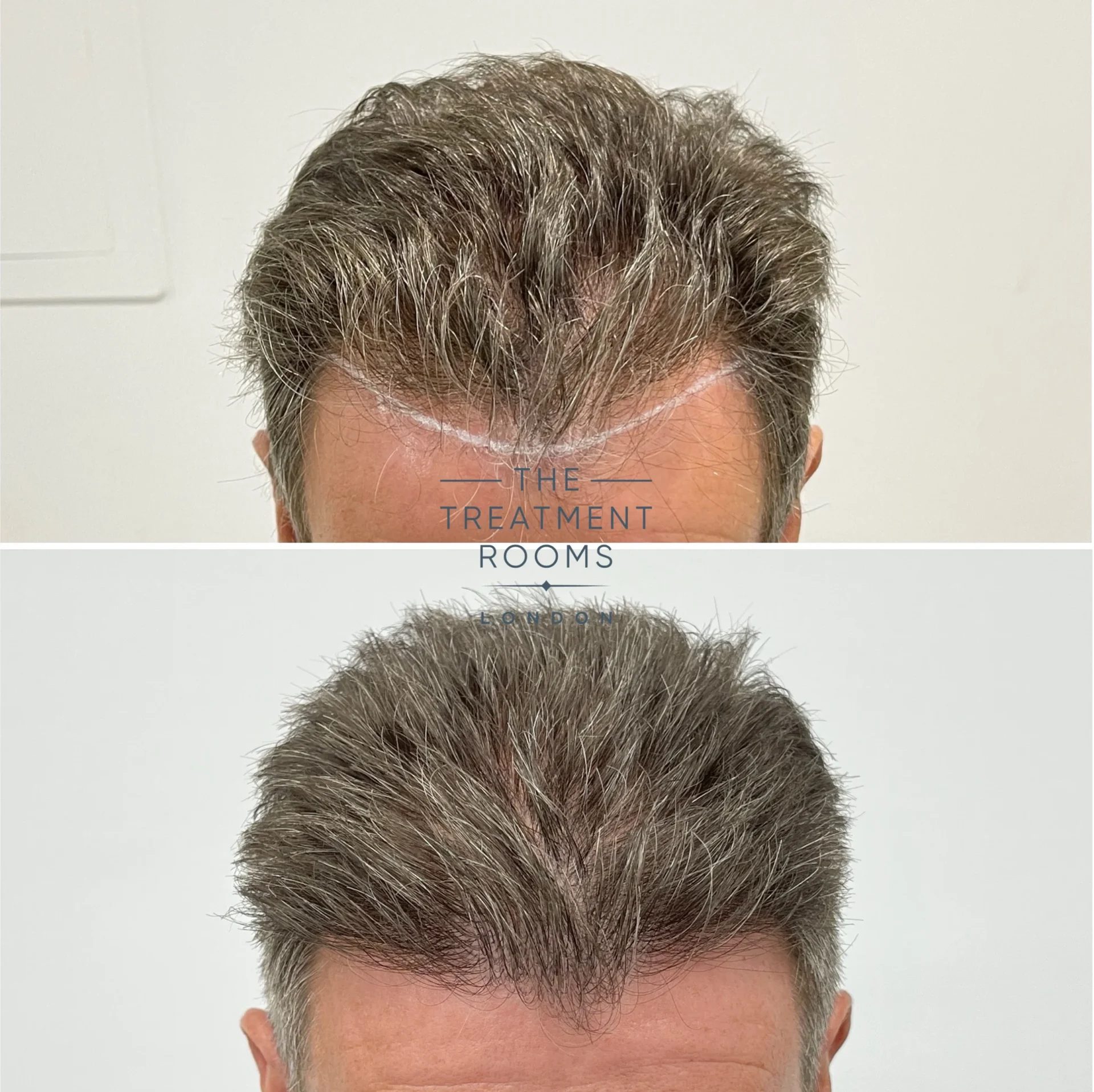 best hair transplant london review