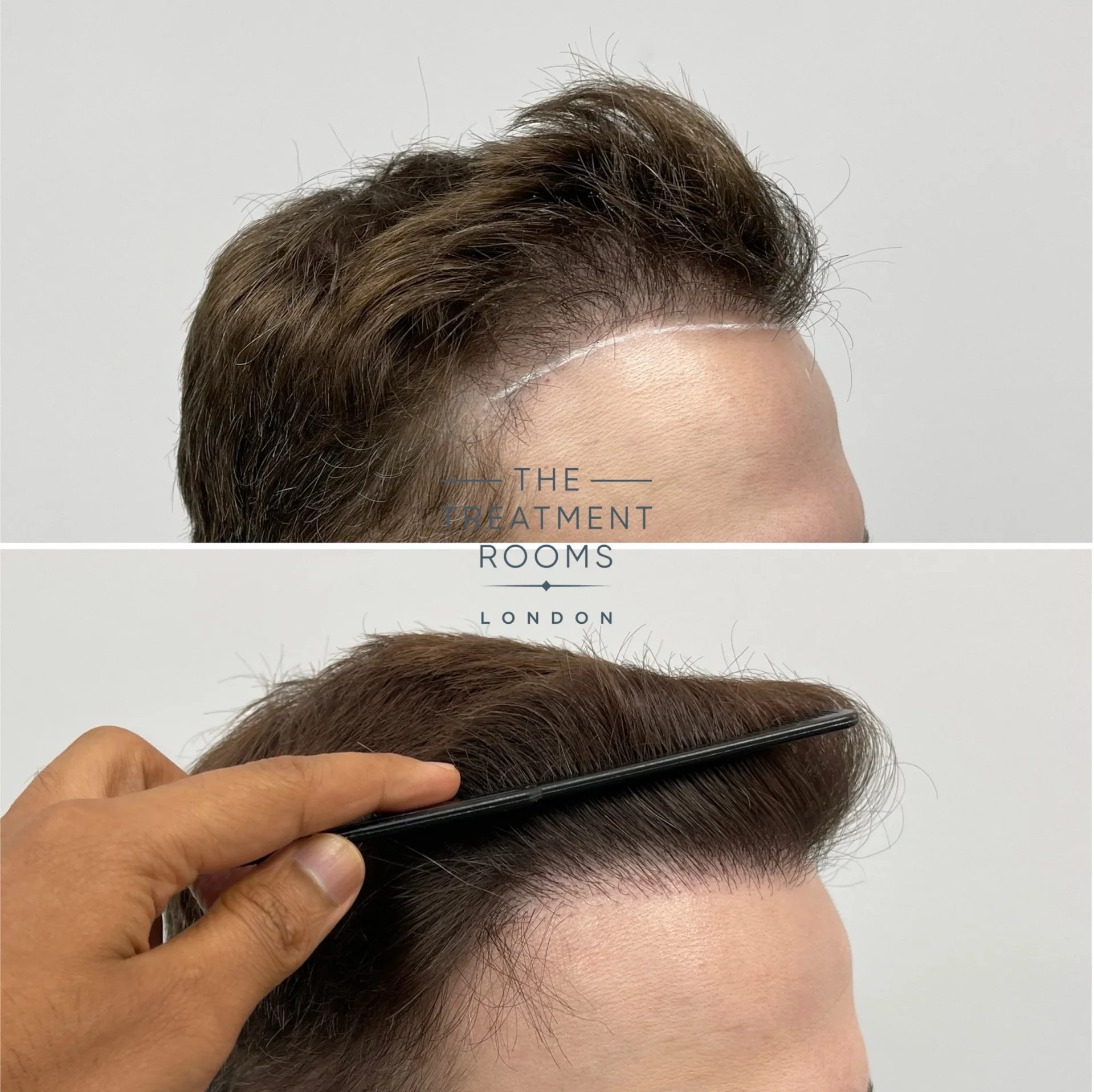 best hair transplant repair 1239 grafts result best hair transplant repair 1239 grafts result
