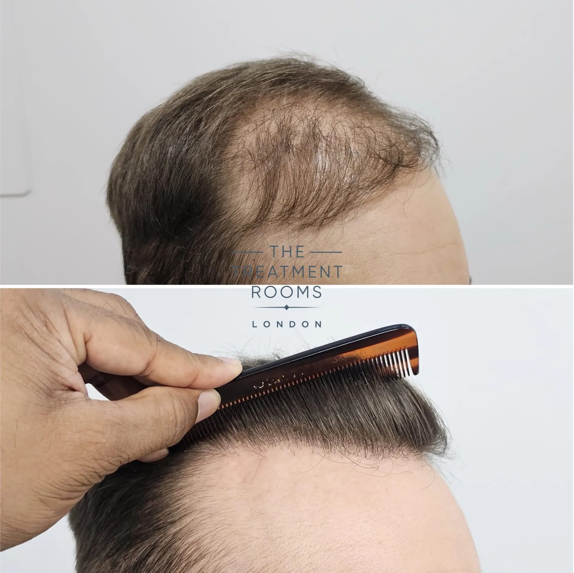 best hair transplant repair 1733 grafts before and after