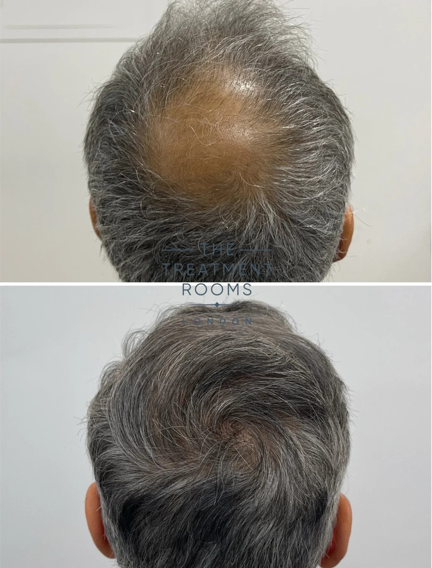 crown hair transplant before and after