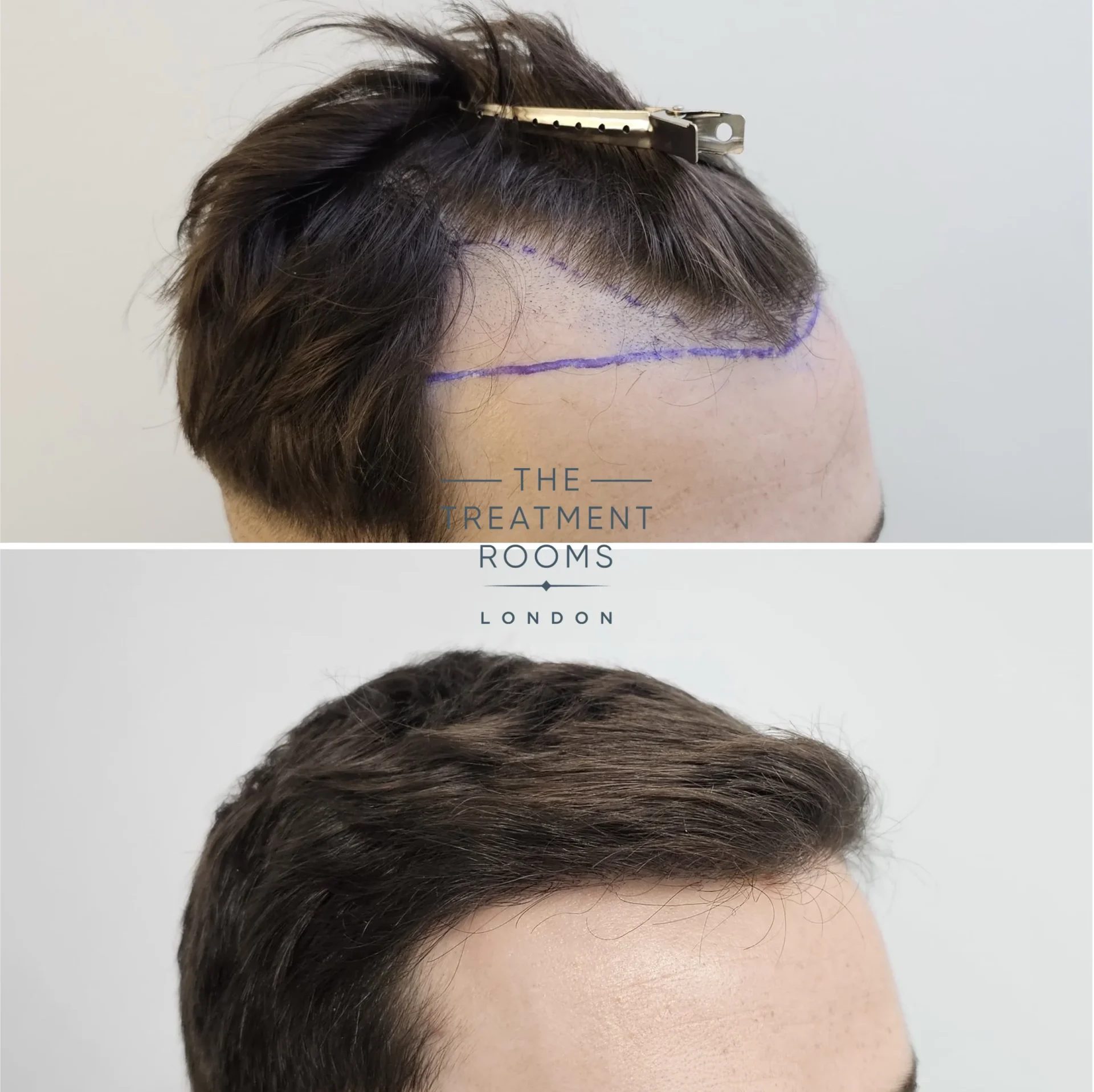 best hairline fue transplant before and after 869 grafts