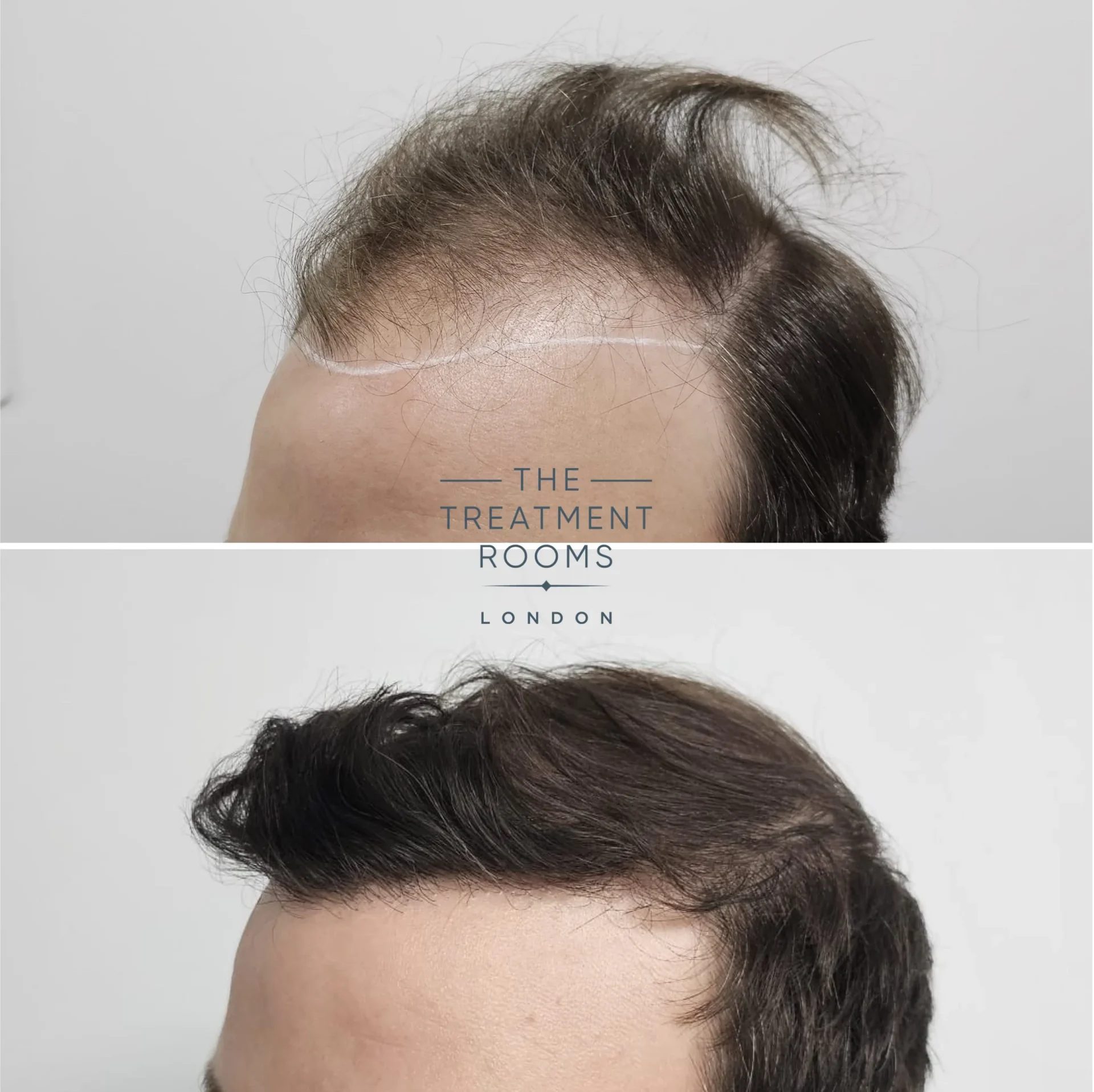 best hairline transplant 2198 grafts before and after