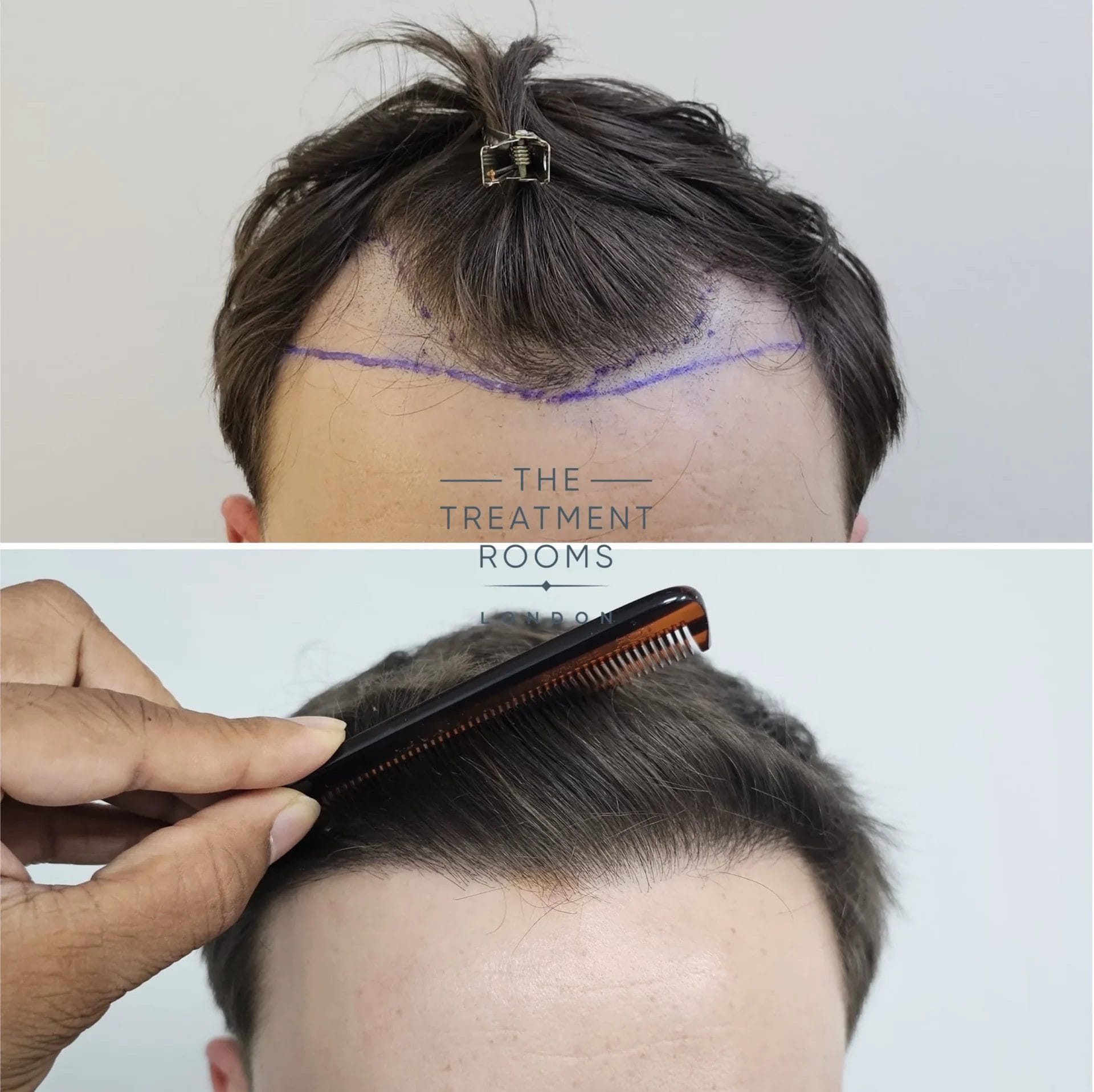 best hairline transplant before and after 869 grafts