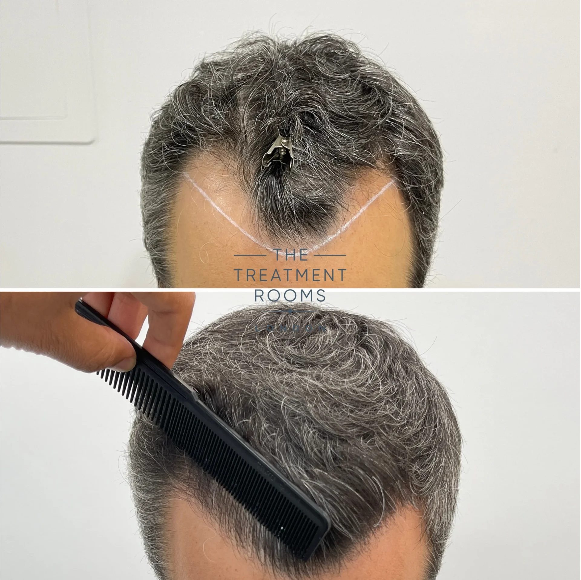 best hairline transplant clinic london 1318 grafts before and after