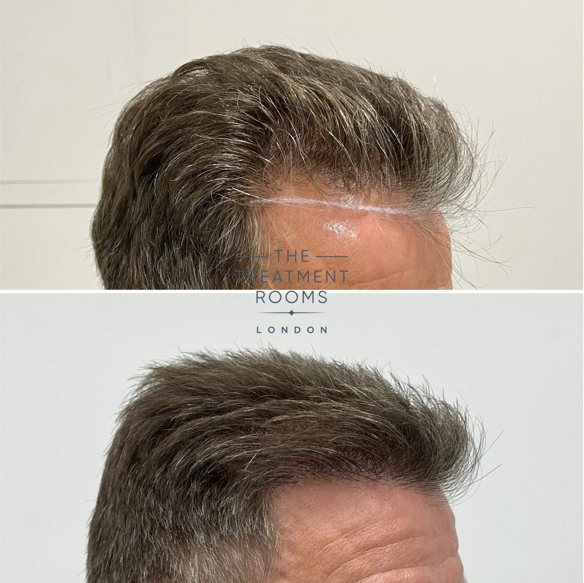 best hairline transplant london 2227 grafts