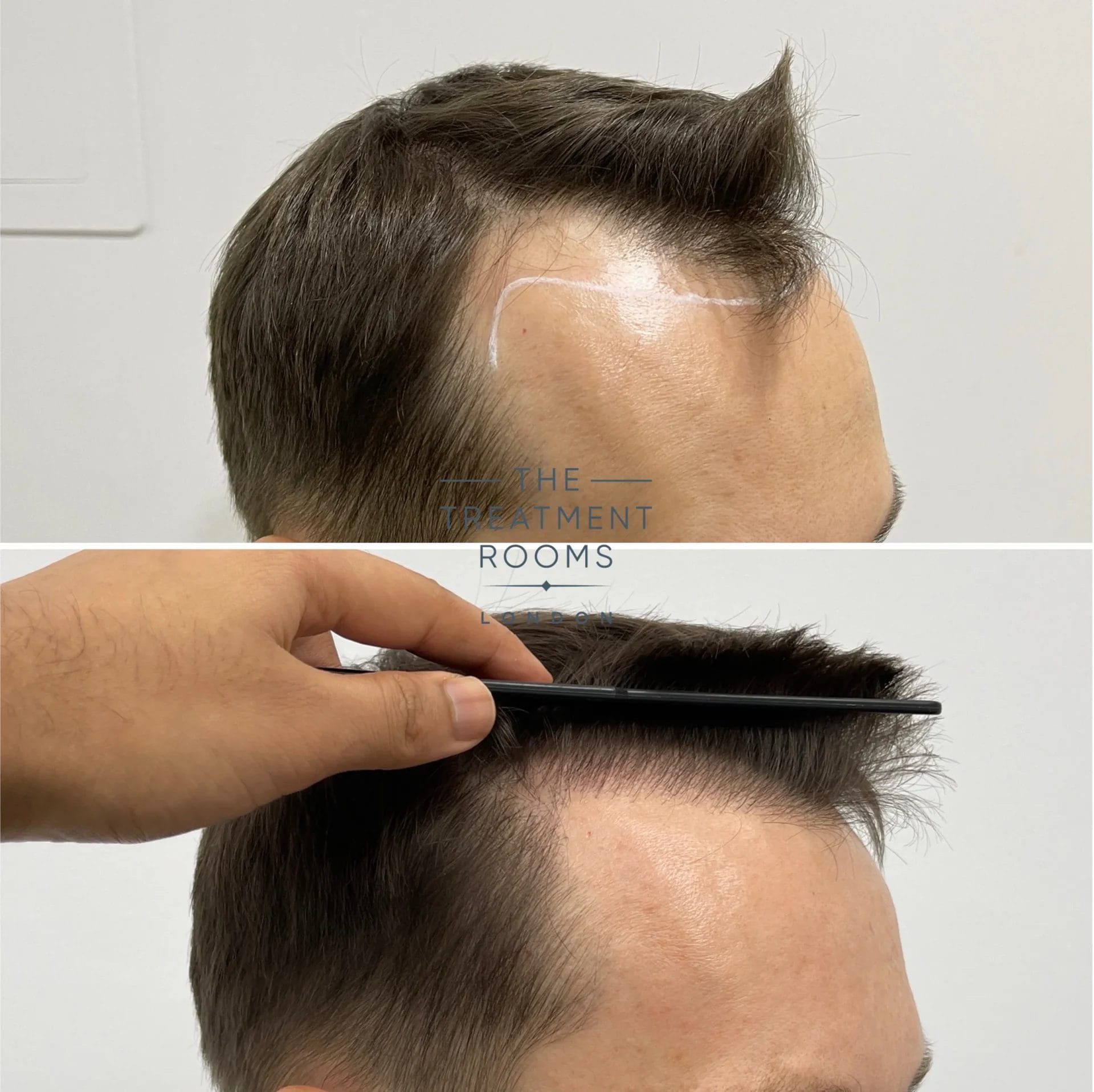 best hairline transplant result 1402 grafts before and after