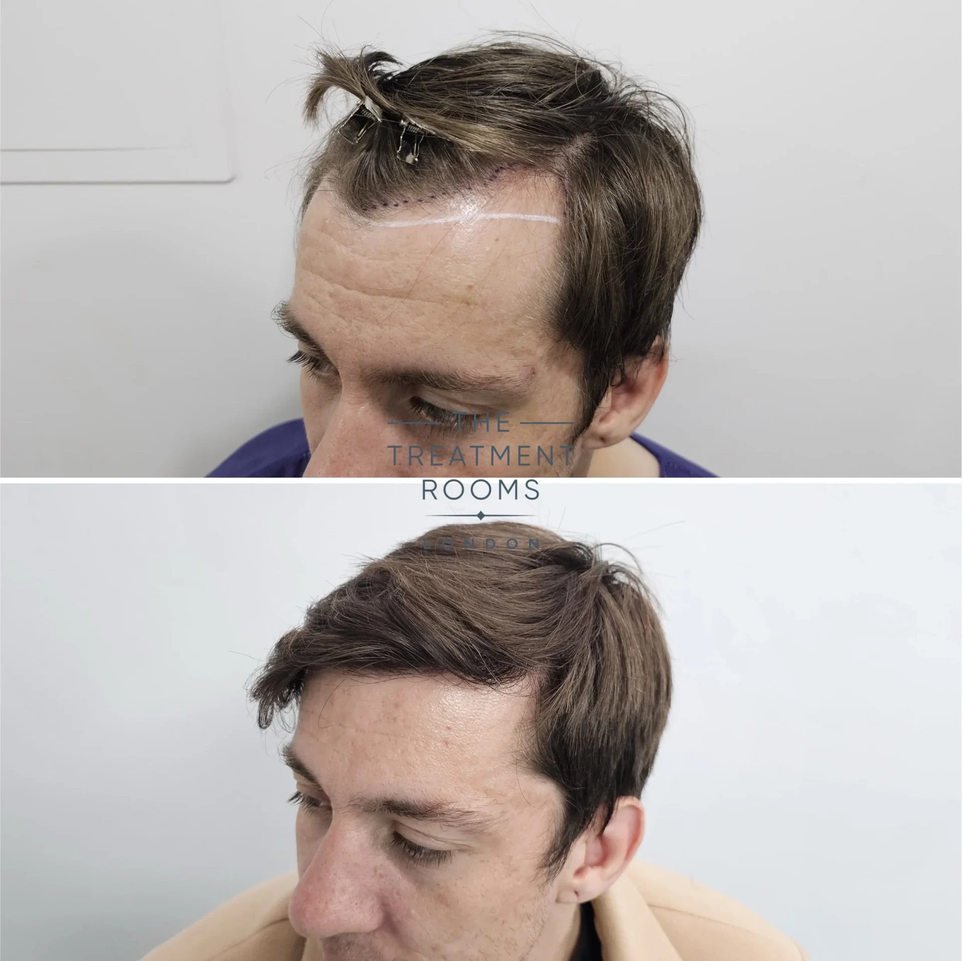 best london hair transplant 1384 grafts before and after surgery