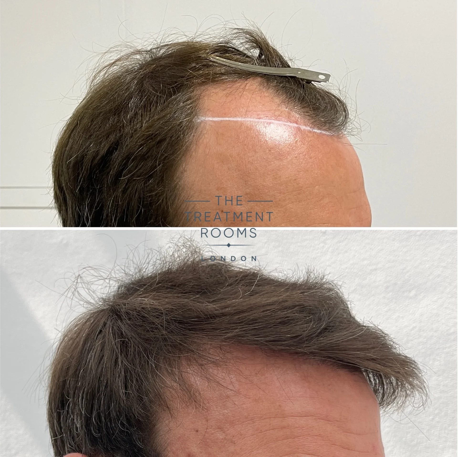 best london hair transplant 3667 grafts before and after