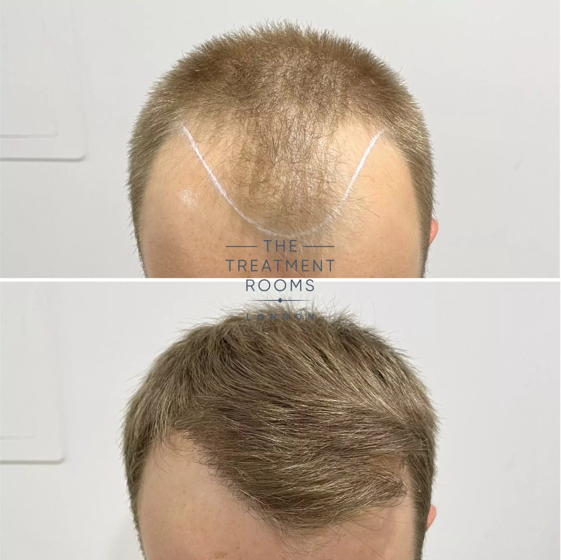 best london hair transplant clinic 1756 grafts result