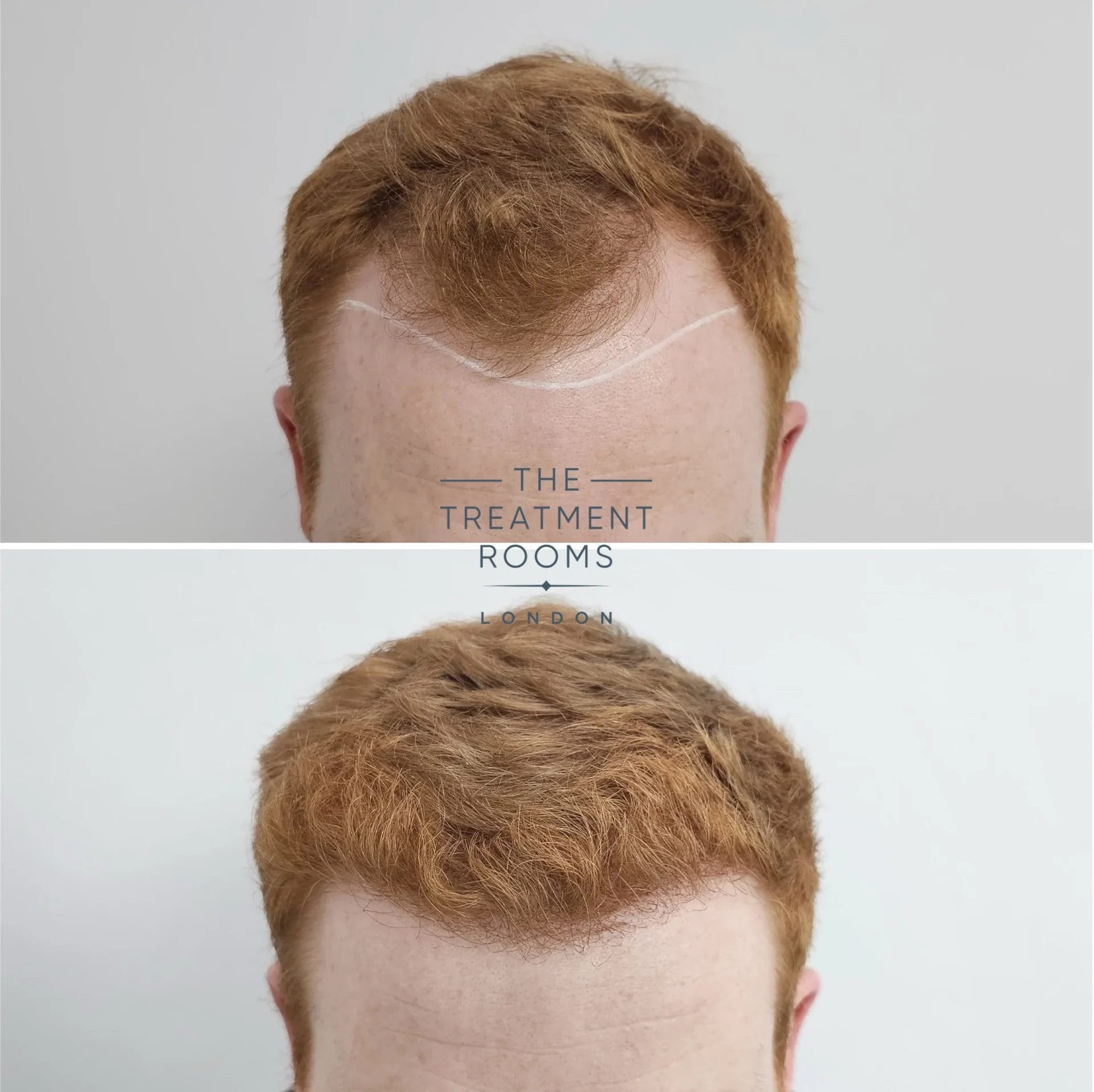 best london hair transplant clinic before and after 1898 grafts