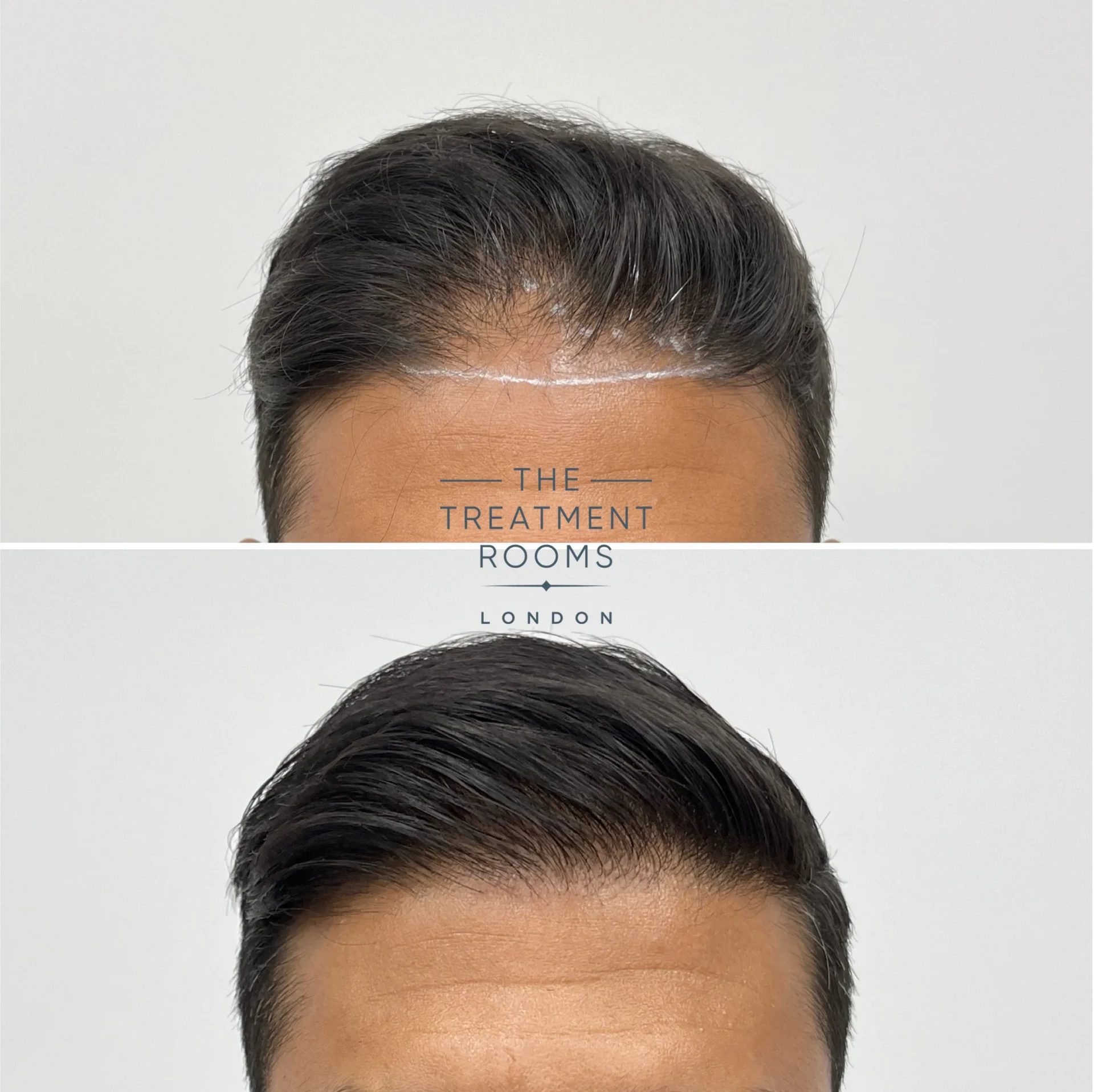 best receding hairline transplant 1411 grafts