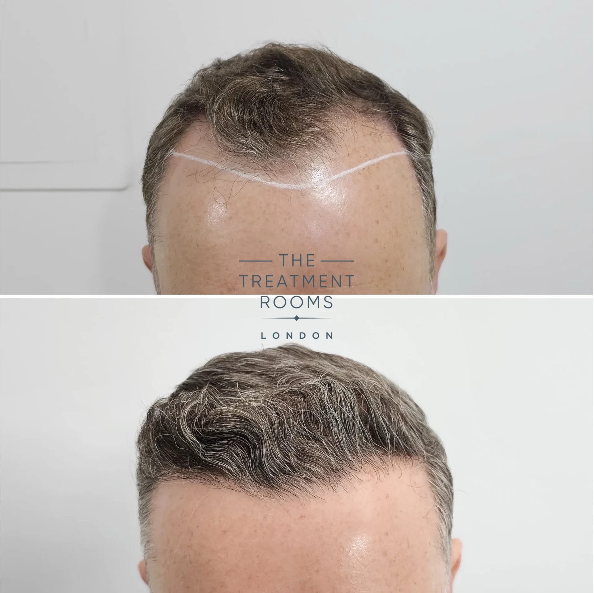 best receding hairline transplant 1820 grafts before and after