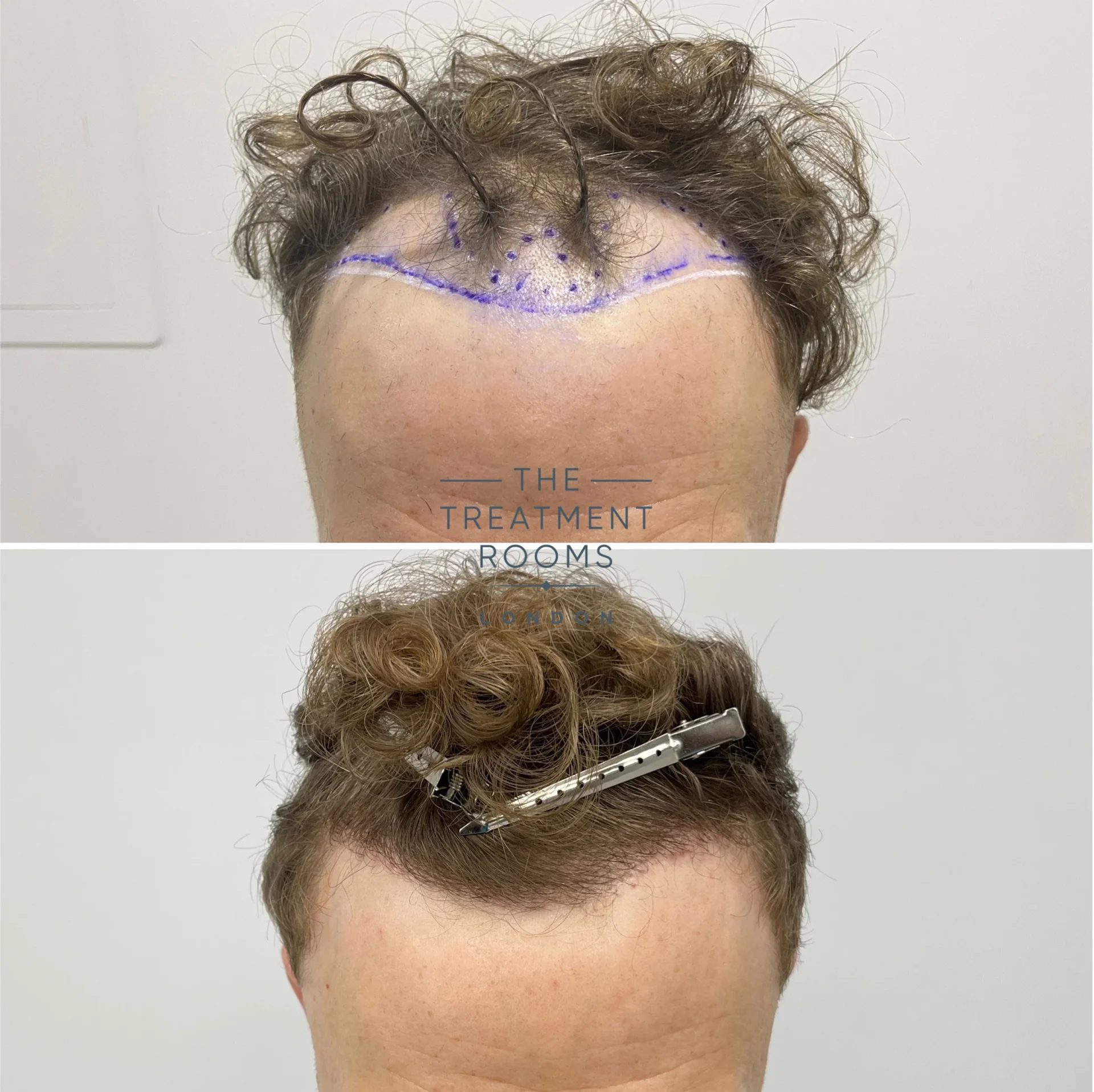best receding hairline transplant clinic london 1514 grafts before and after best receding hairline transplant clinic london 1514 grafts before and after
