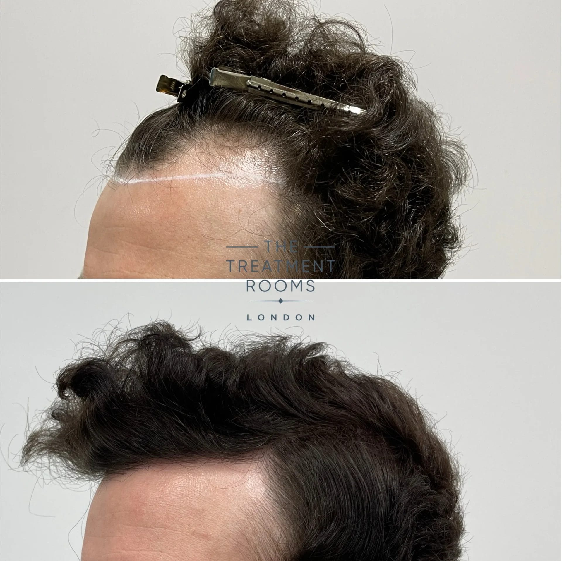 best receding temples and hairline transplant before and after 1306 grafts