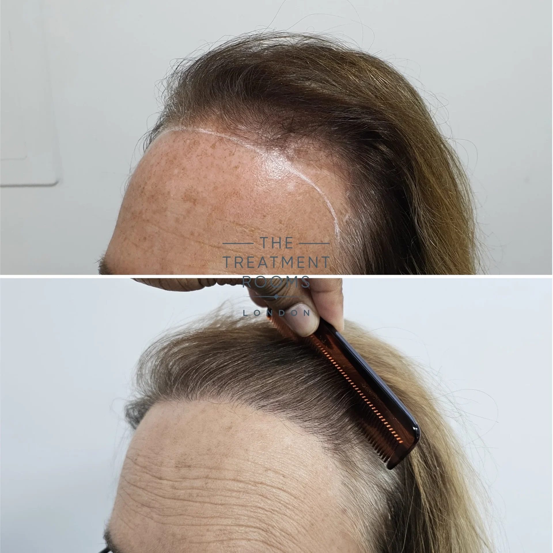best transgender hair transplant clinic before and after 2483 grafts
