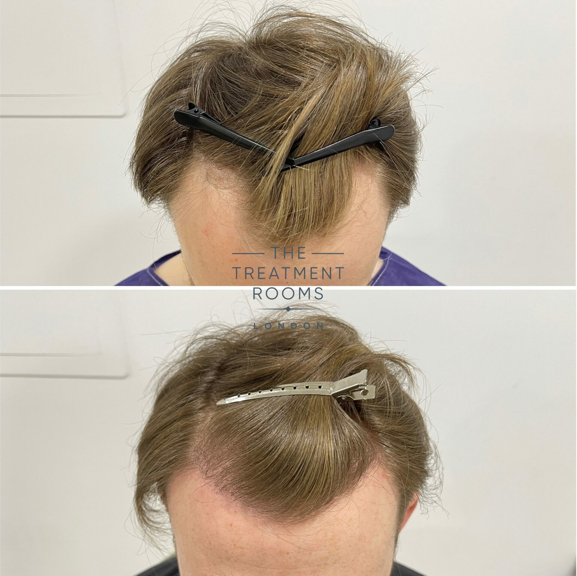 blonde hair fue hair transplant result 1700 grafts