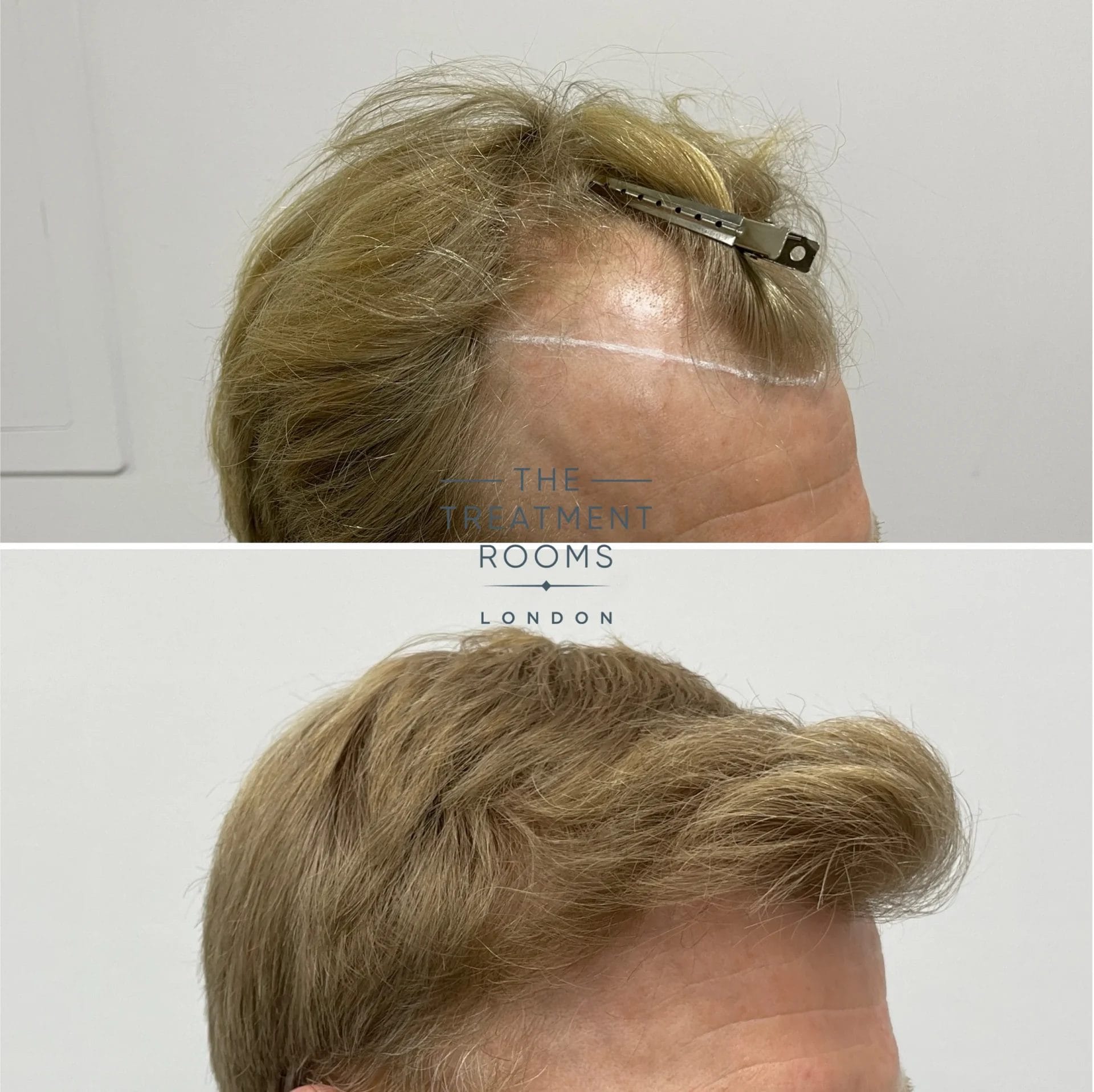 blonde hair fue transplant london 2087 grafts
