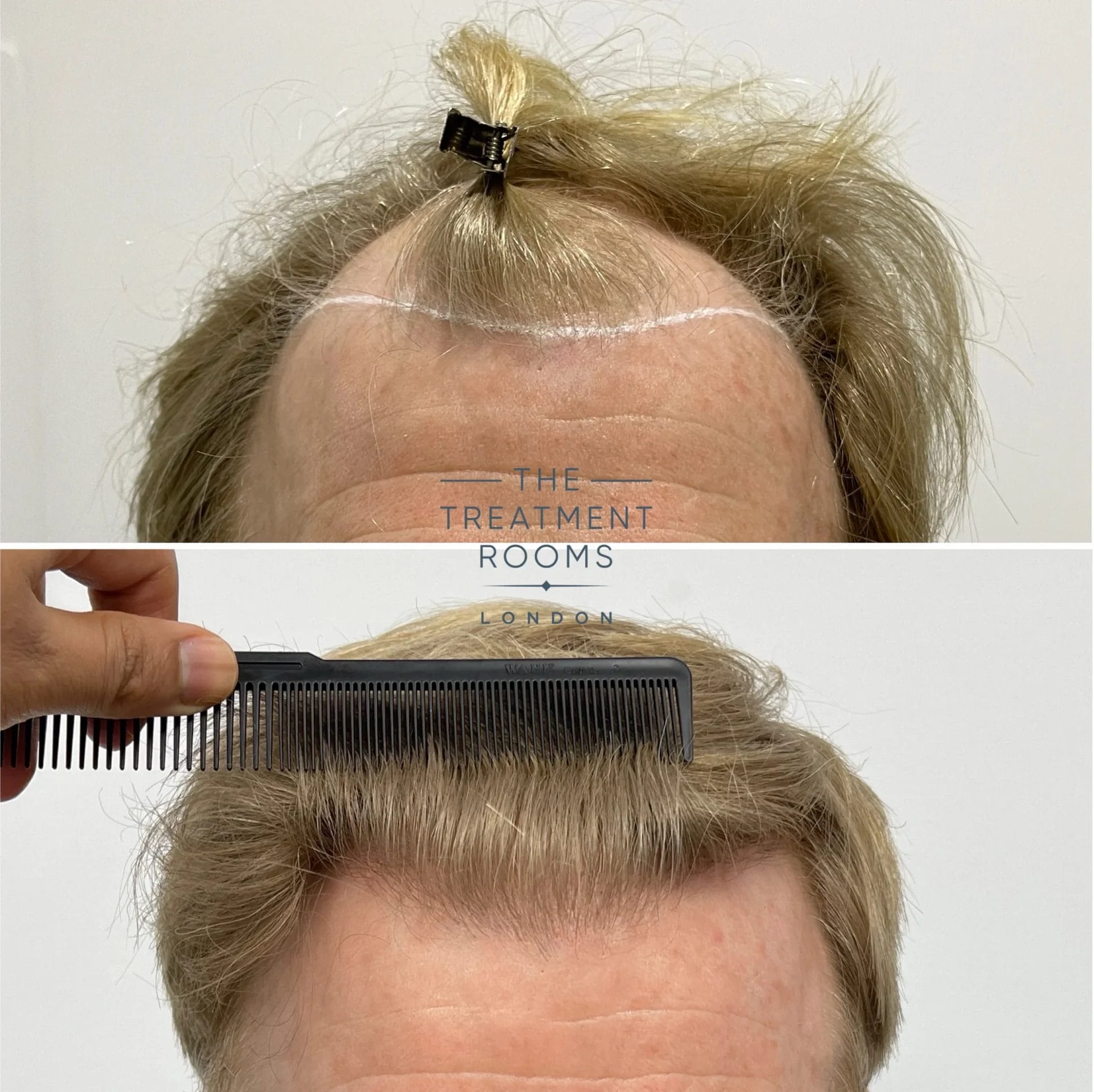 blonde hair transplant london 2087 grafts result