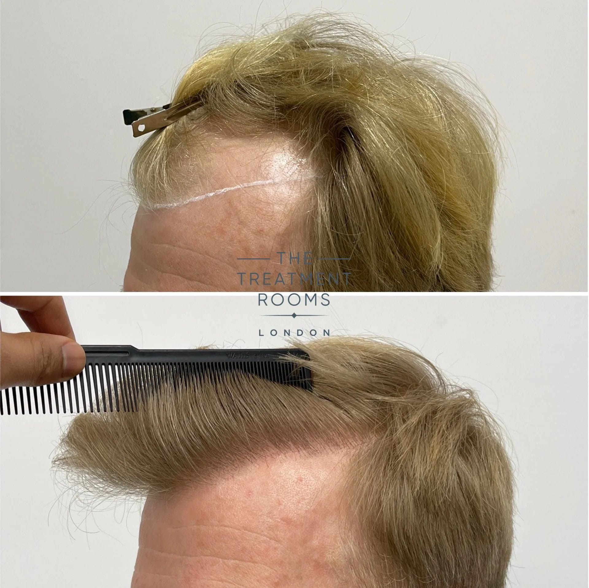 blonde hair transplant london 2087 grafts