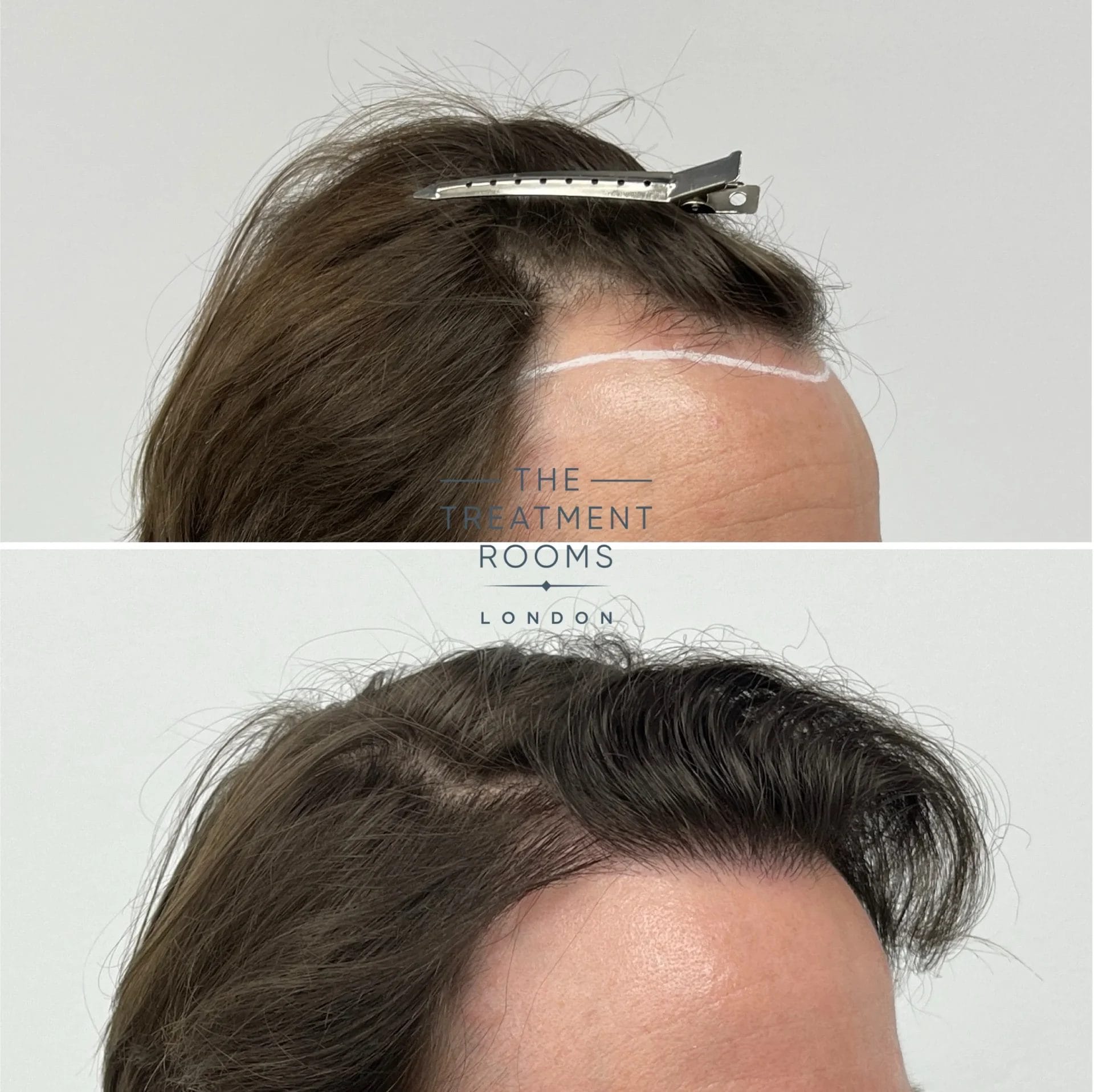 brown hair transplant 1398 grafts before and after