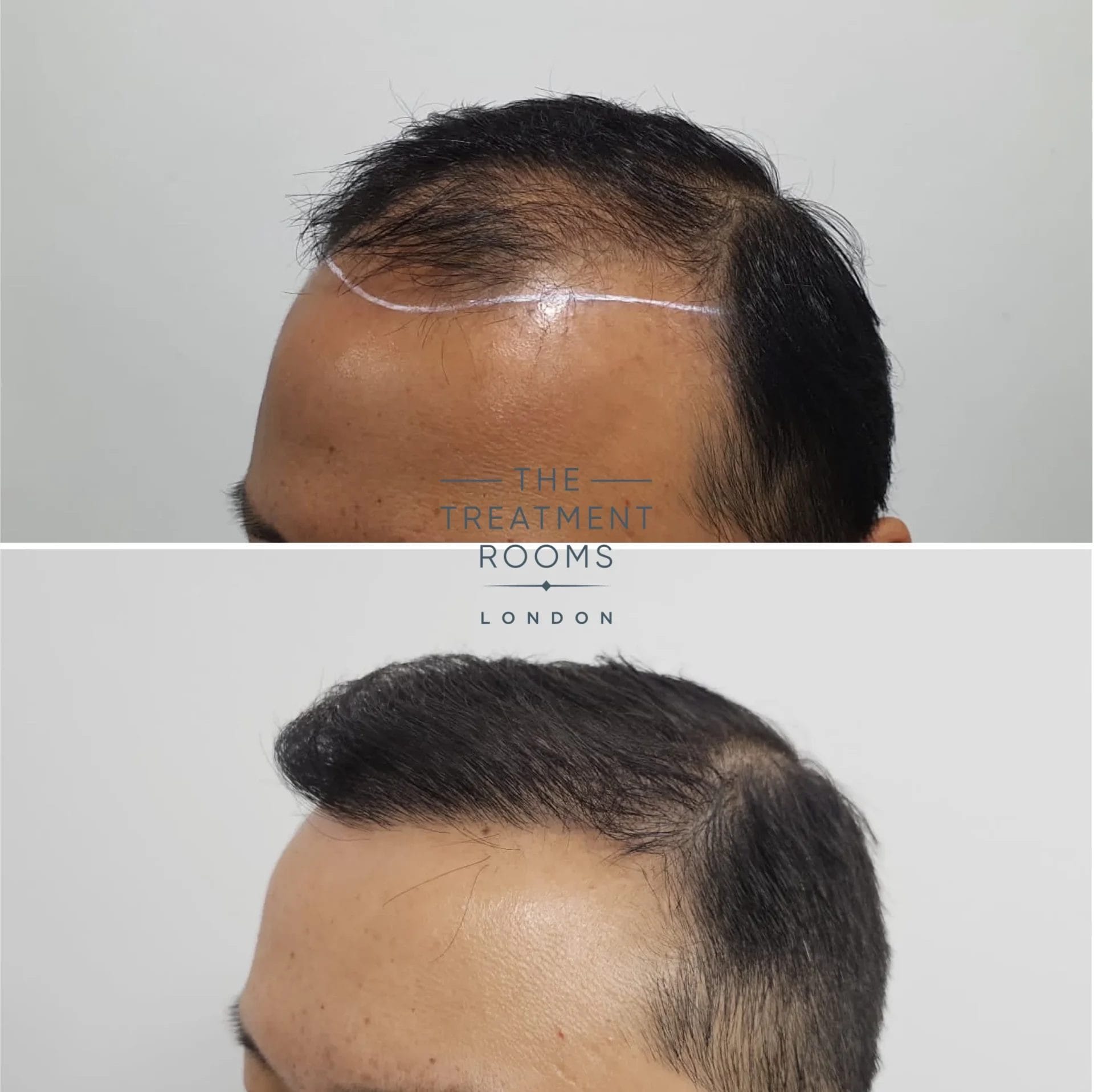 chinese hair transplant london 2036 grafts