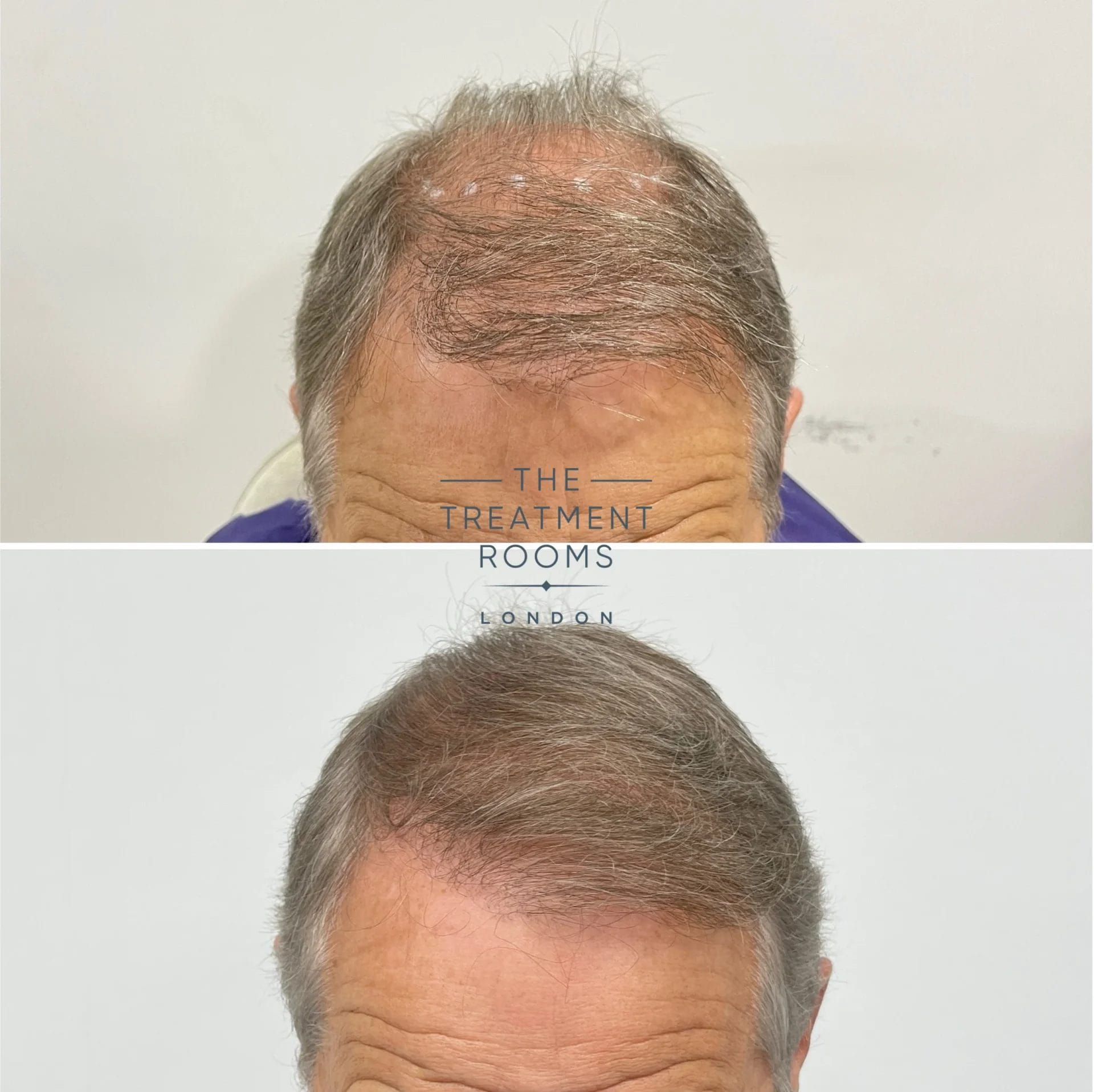 crown and hairline fue transplant before and after 2024 grafts