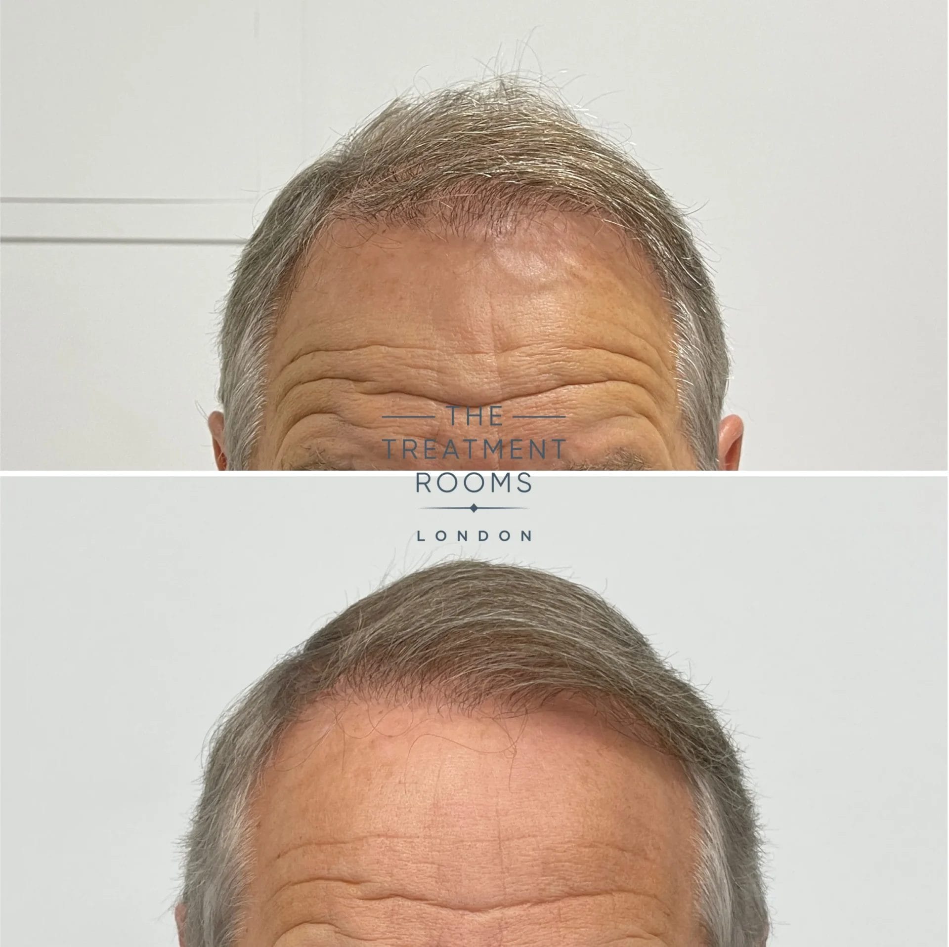 crown and hairline transplant before and after 2024 grafts