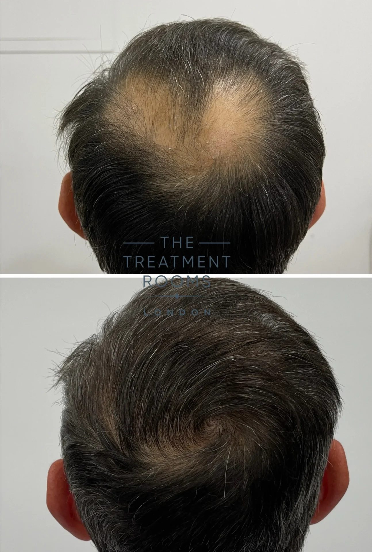 crown fue hair transplant 1877 grafts before and after