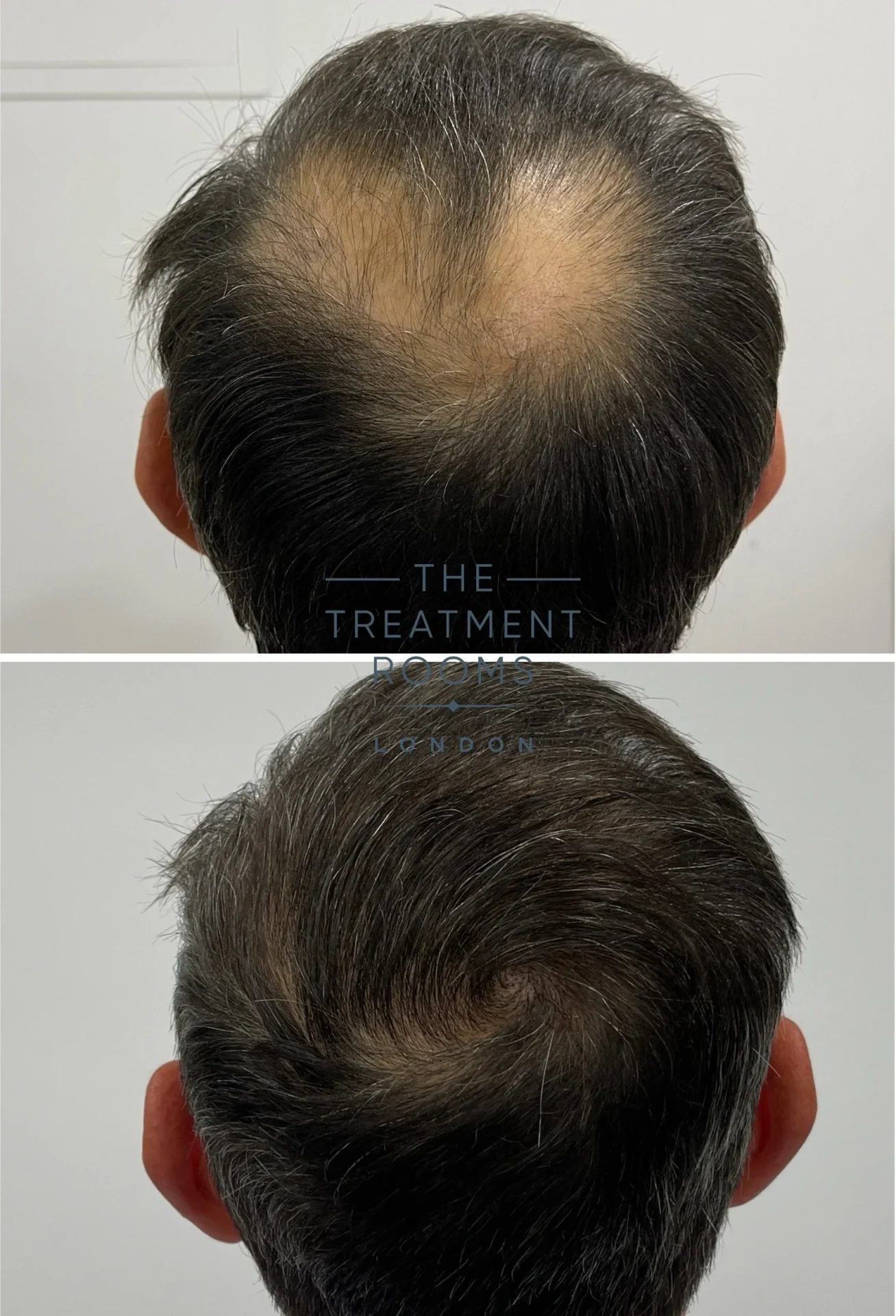 crown hair transplant 1877 grafts before and after