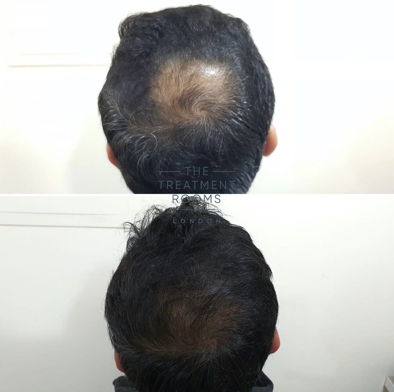 crown hair transplant