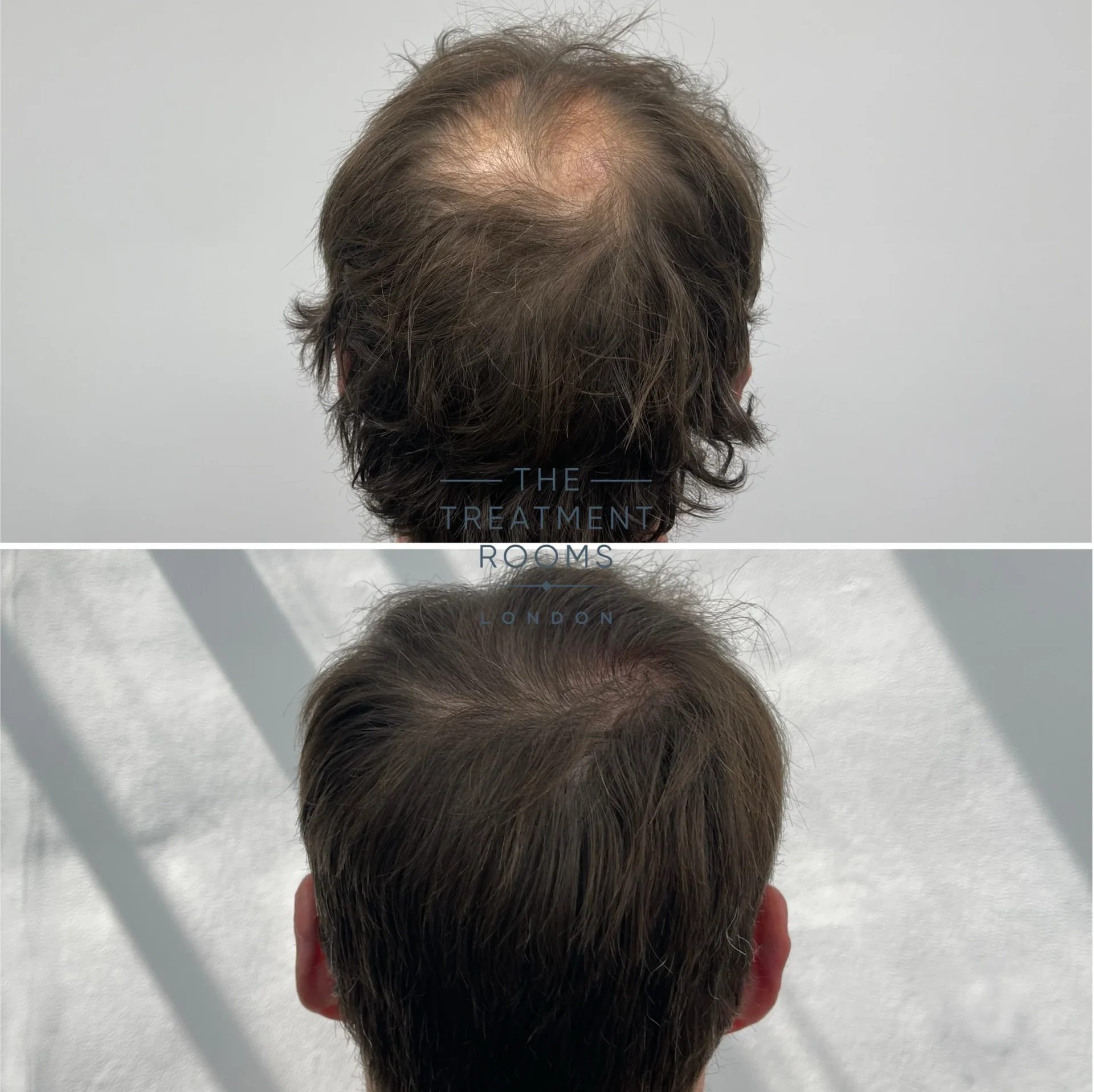 crown hair transplant 3667 grafts before and after