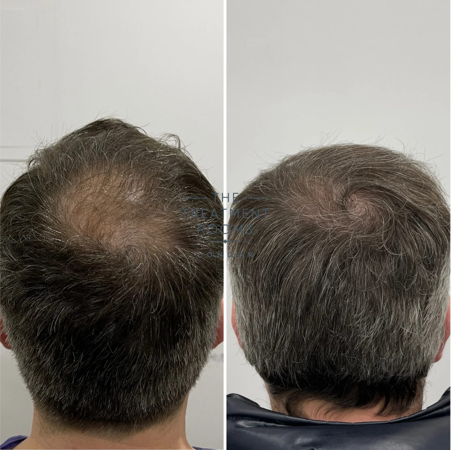 crown hair transplant before and after